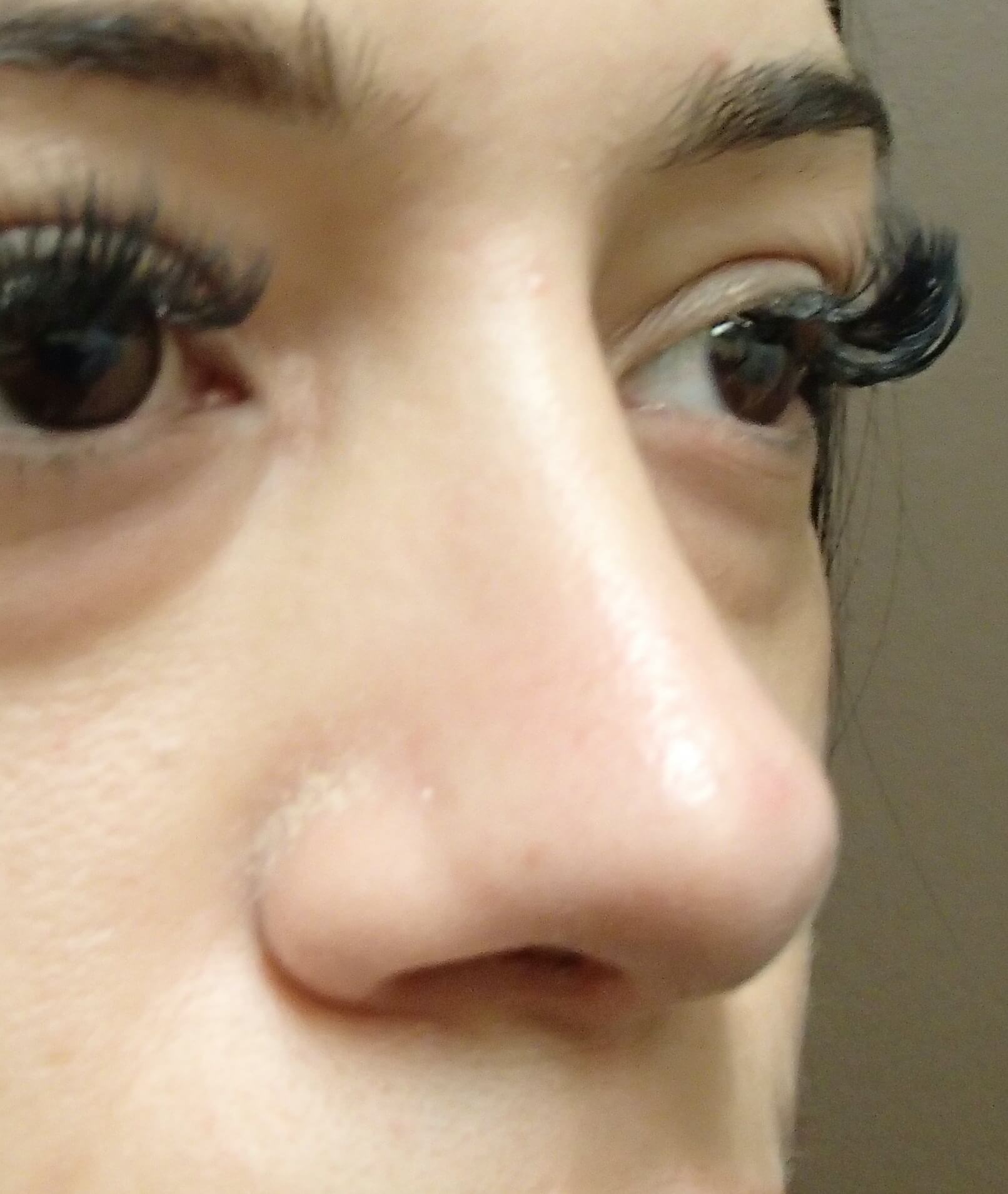 Rhinoplasty After