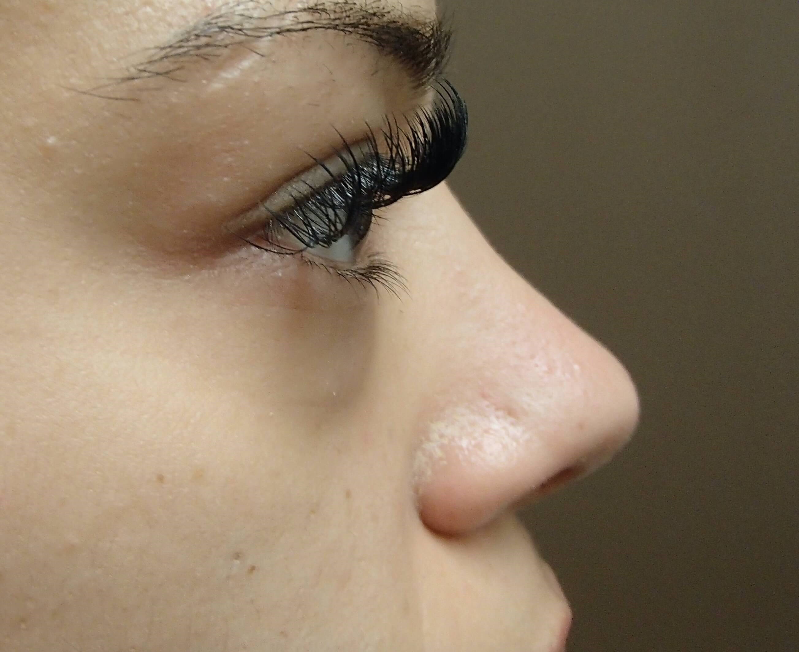 Rhinoplasty After