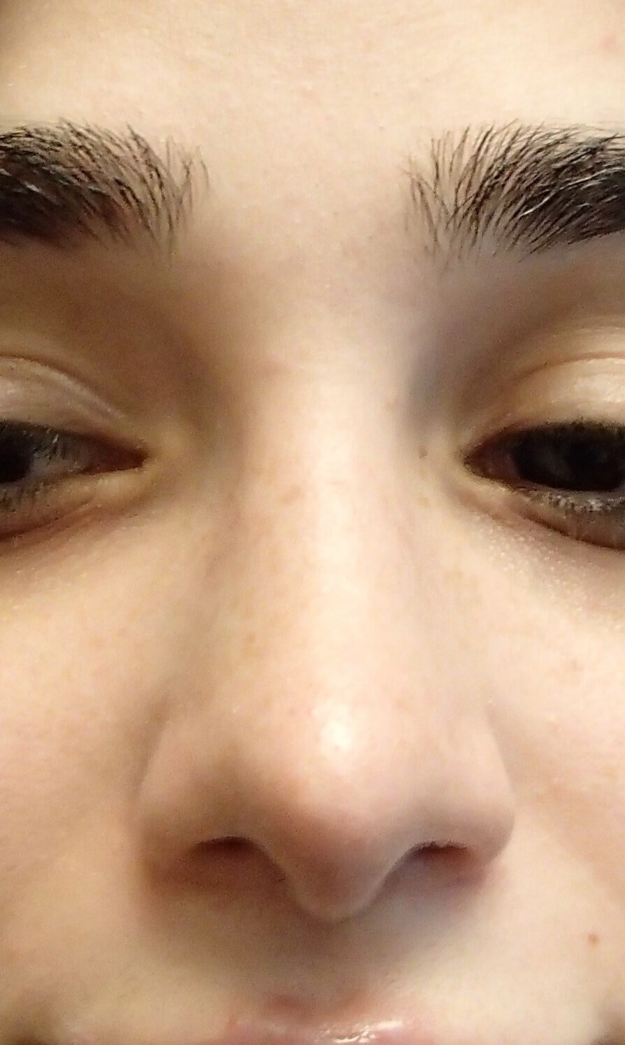 Rhinoplasty After