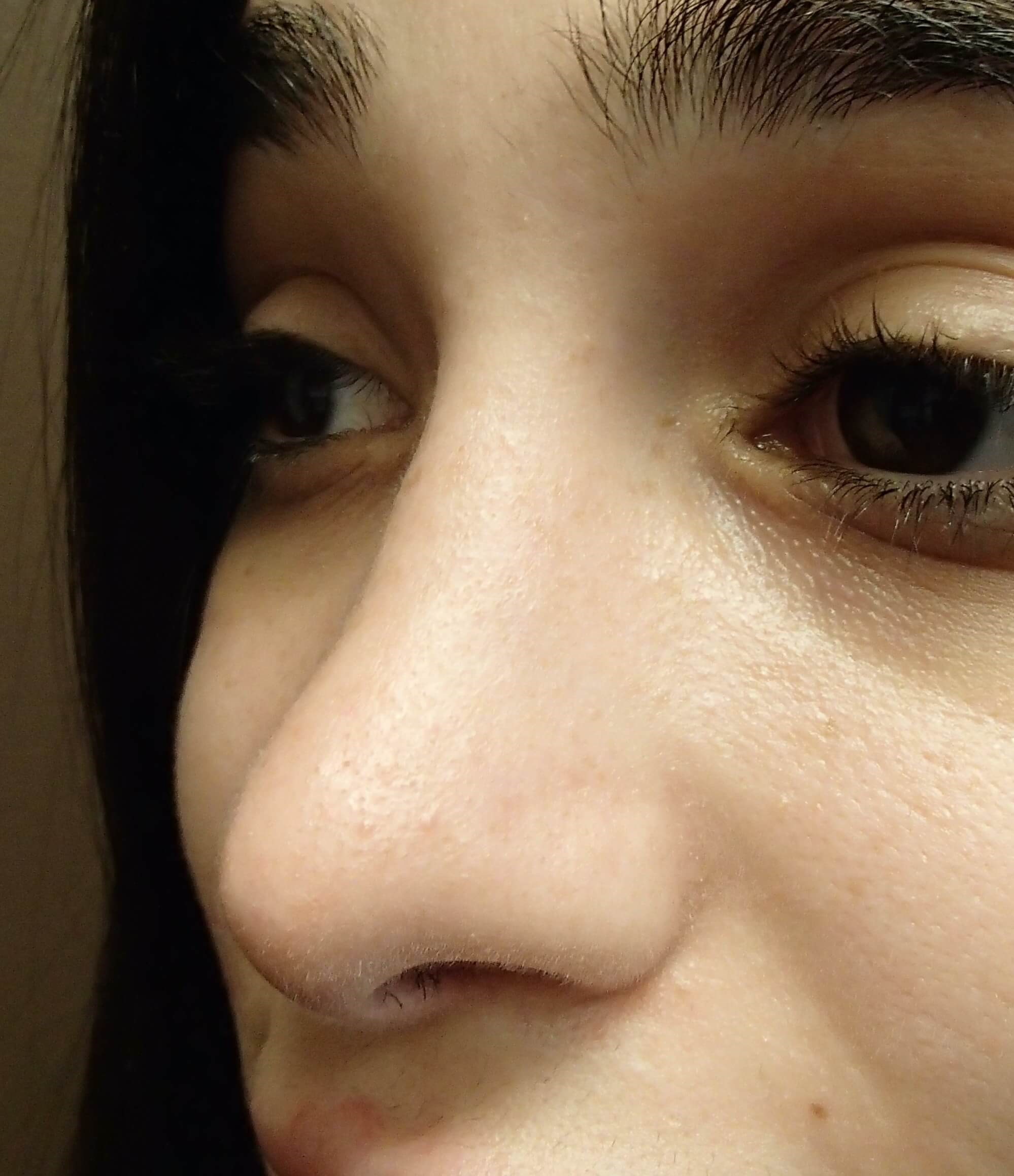 Rhinoplasty After