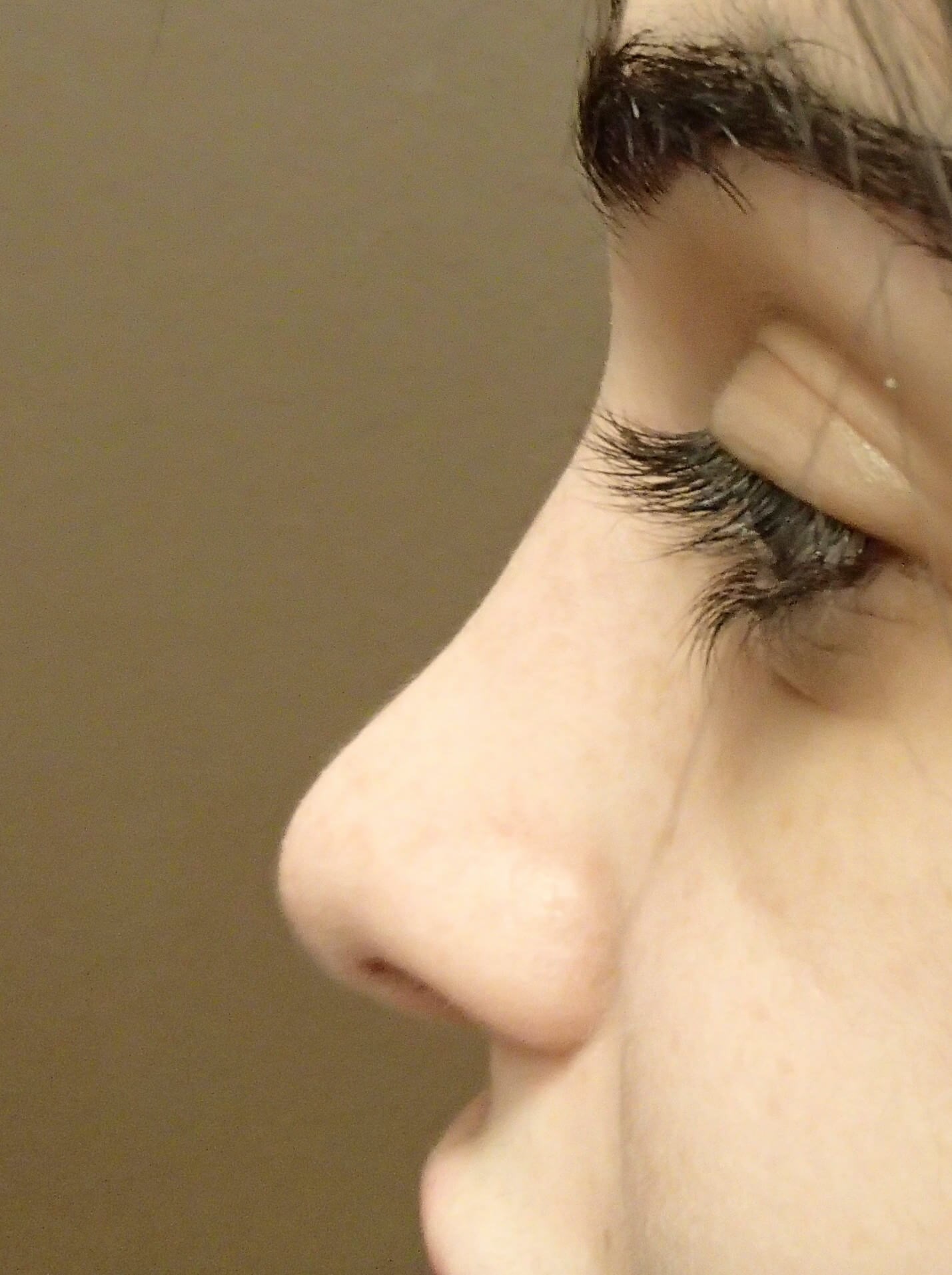 Rhinoplasty After