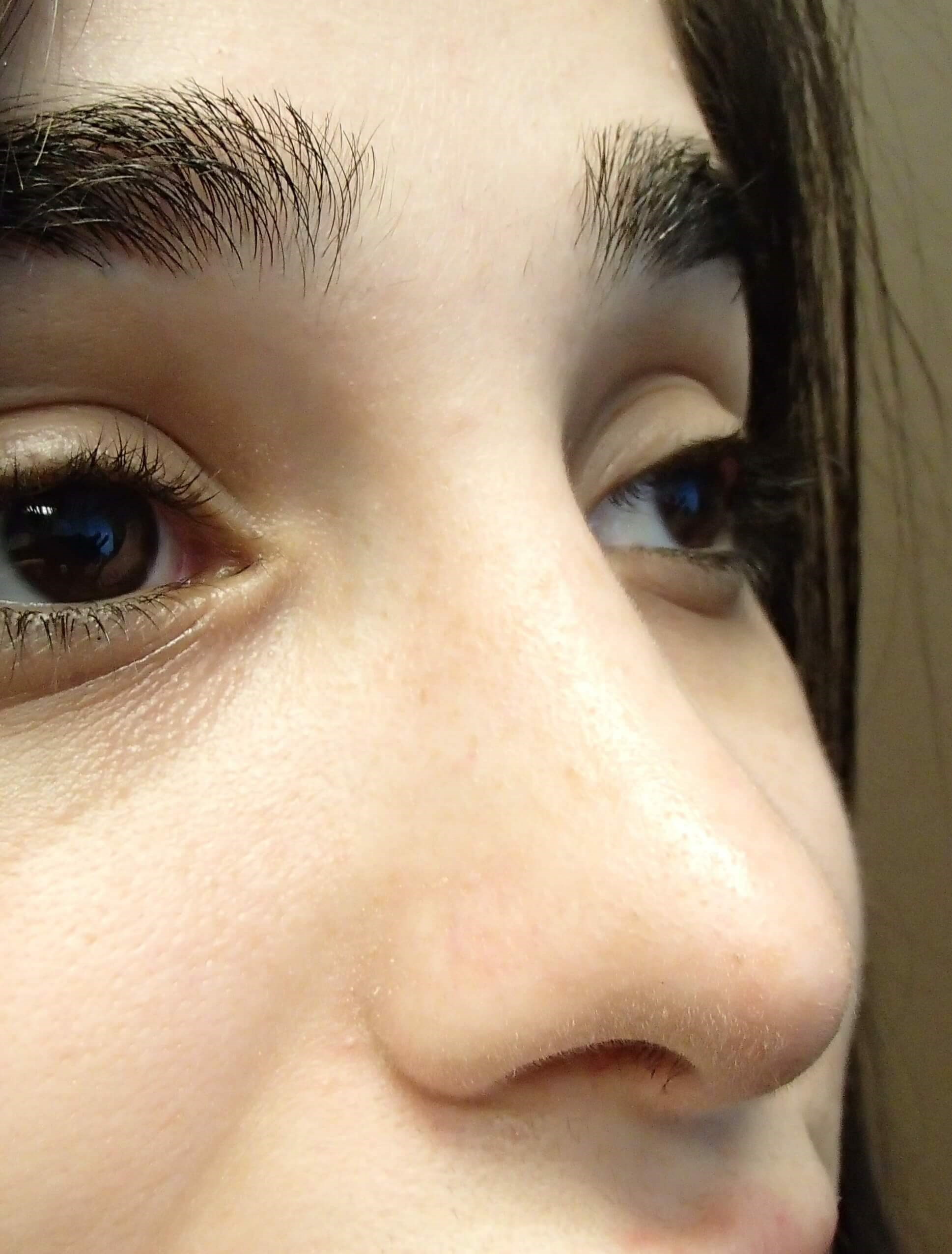 Rhinoplasty After