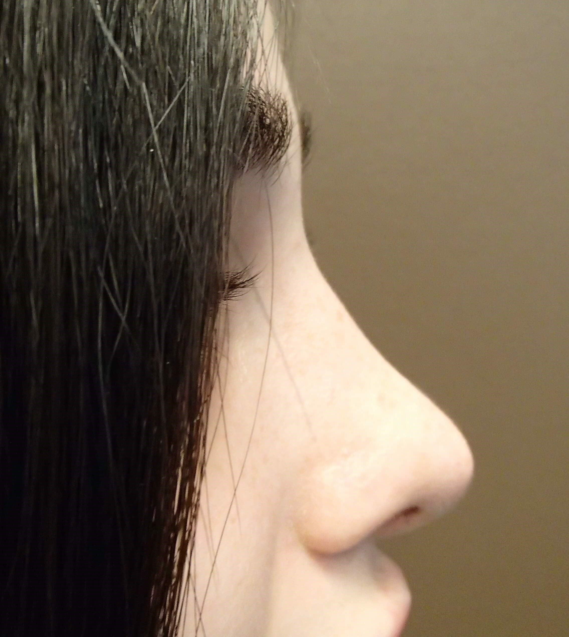 Rhinoplasty After