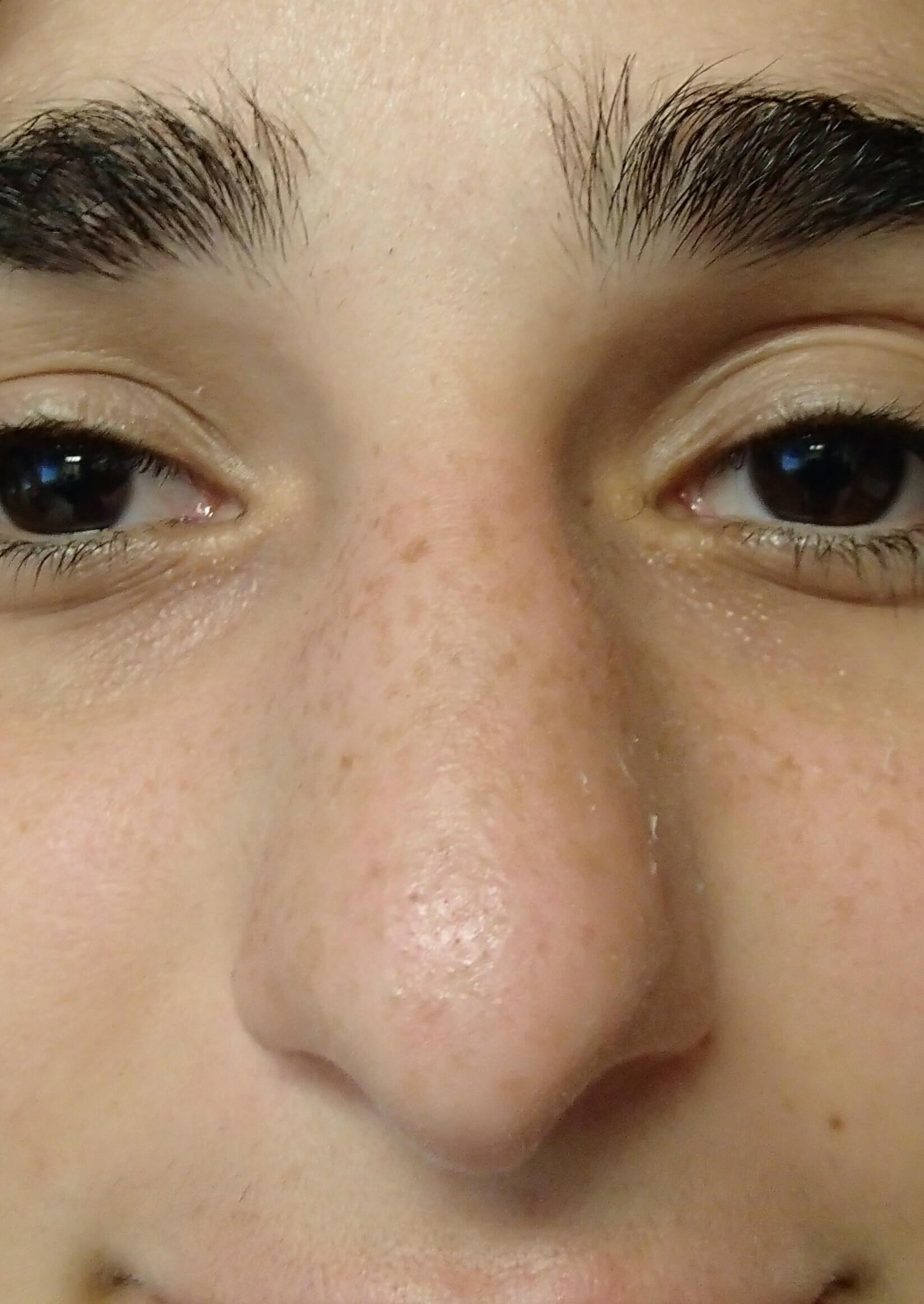 Rhinoplasty Before