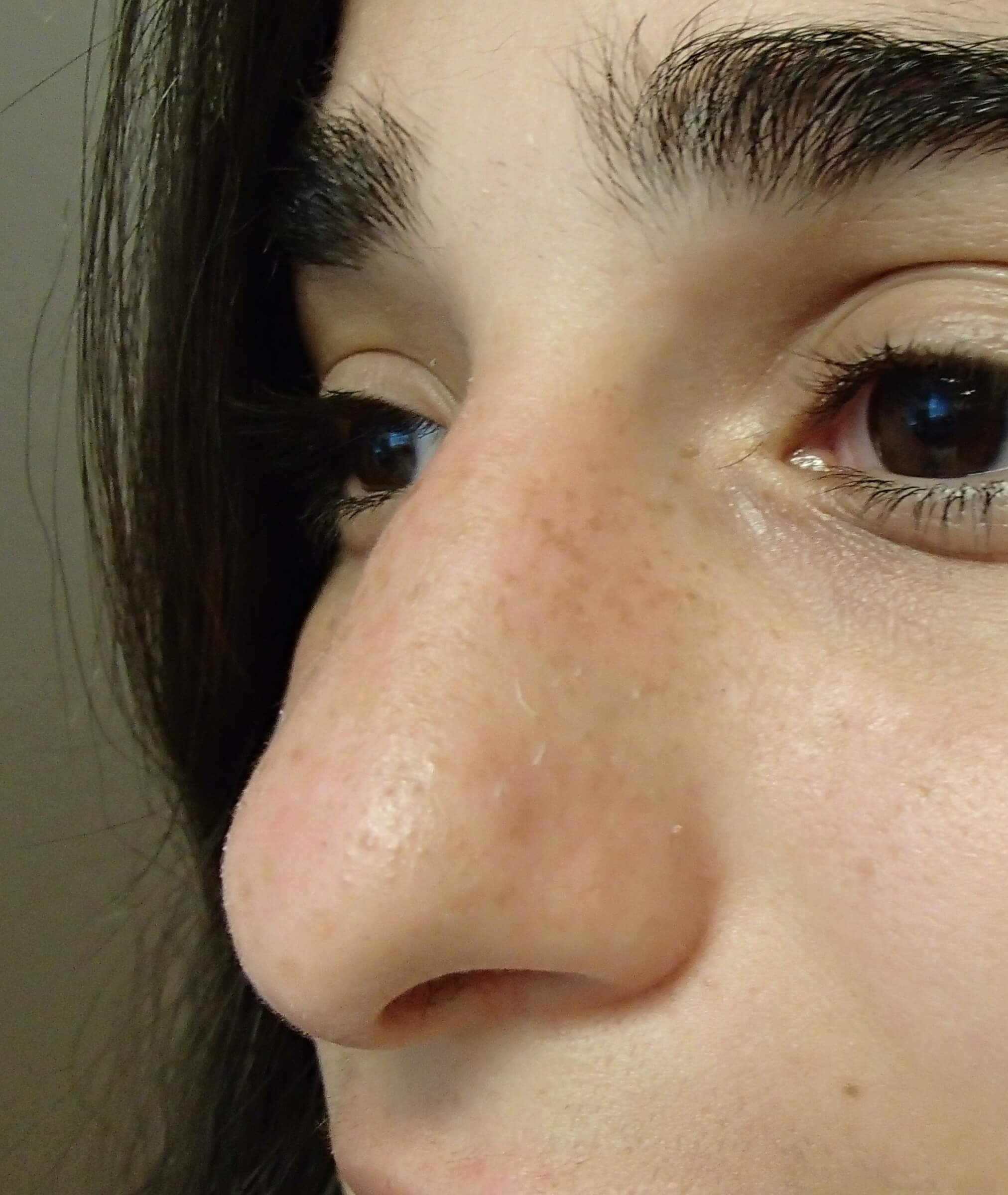 Rhinoplasty Before