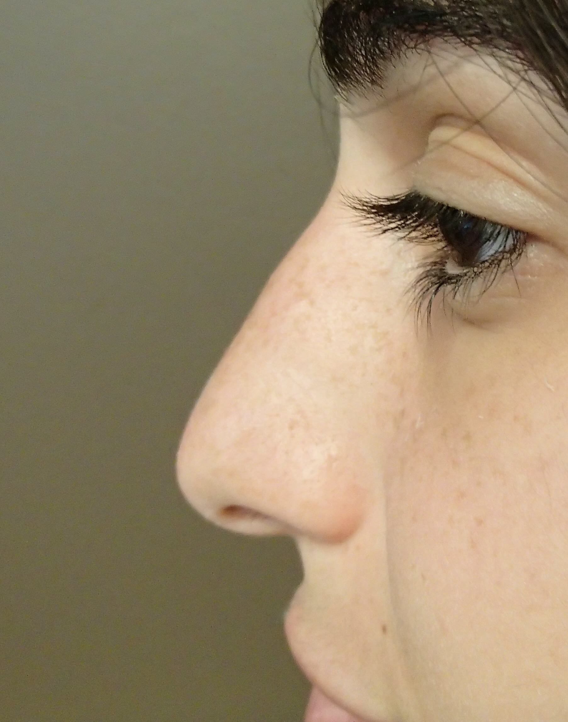 Rhinoplasty Before