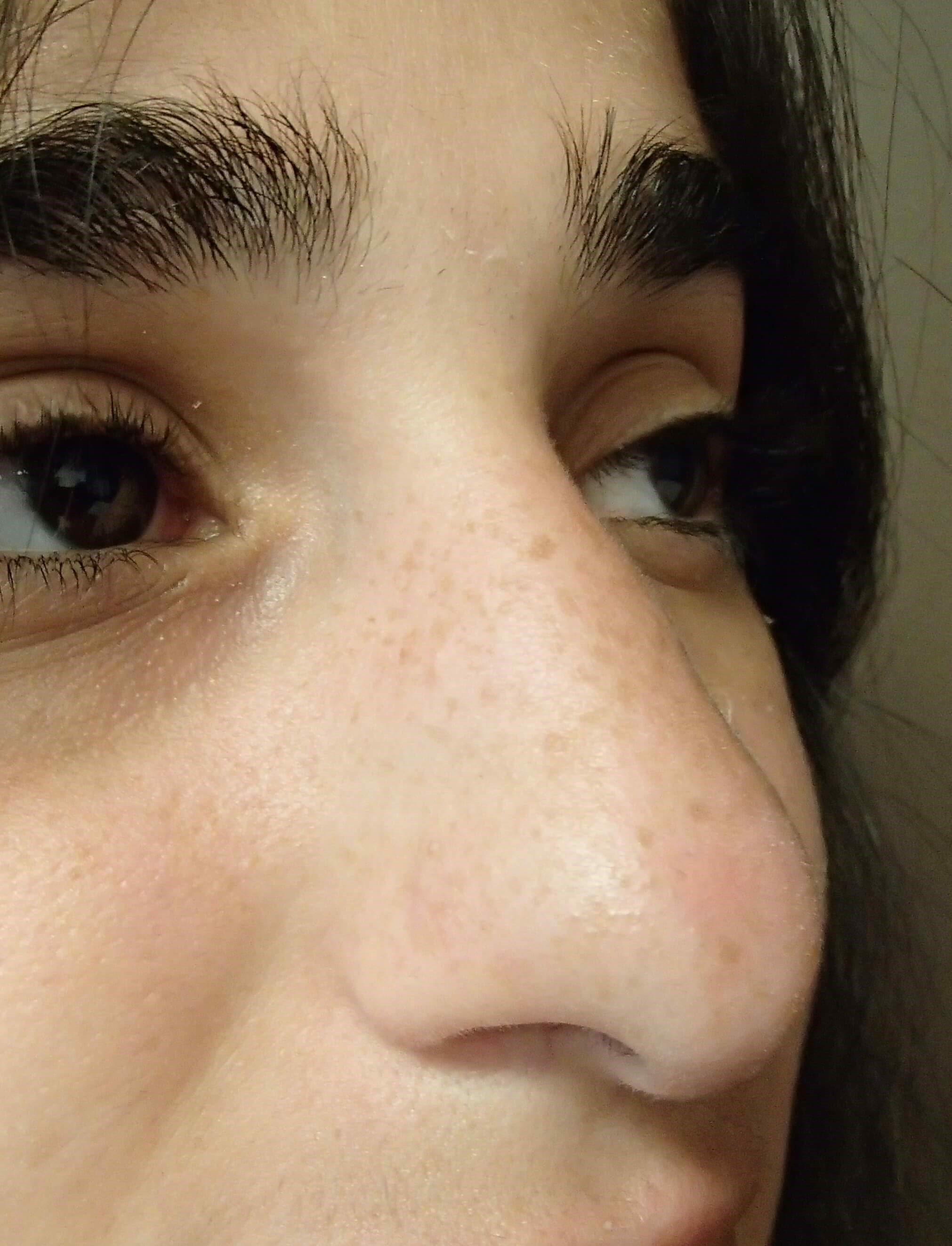 Rhinoplasty Before