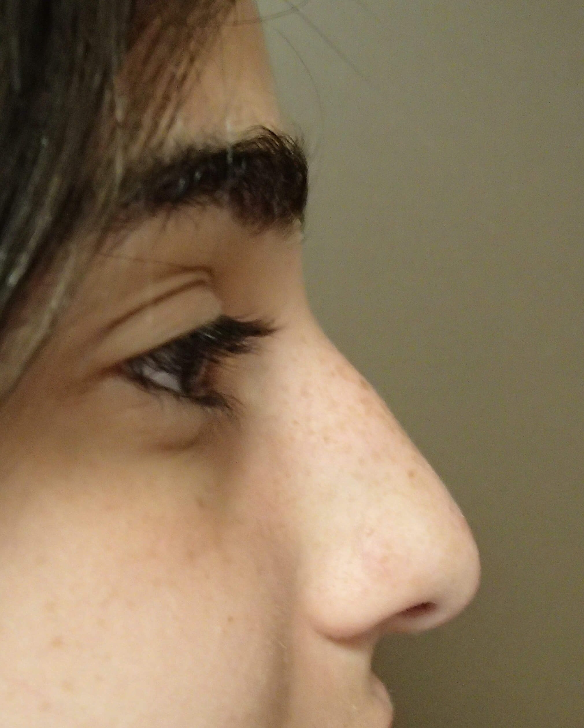 Rhinoplasty Before