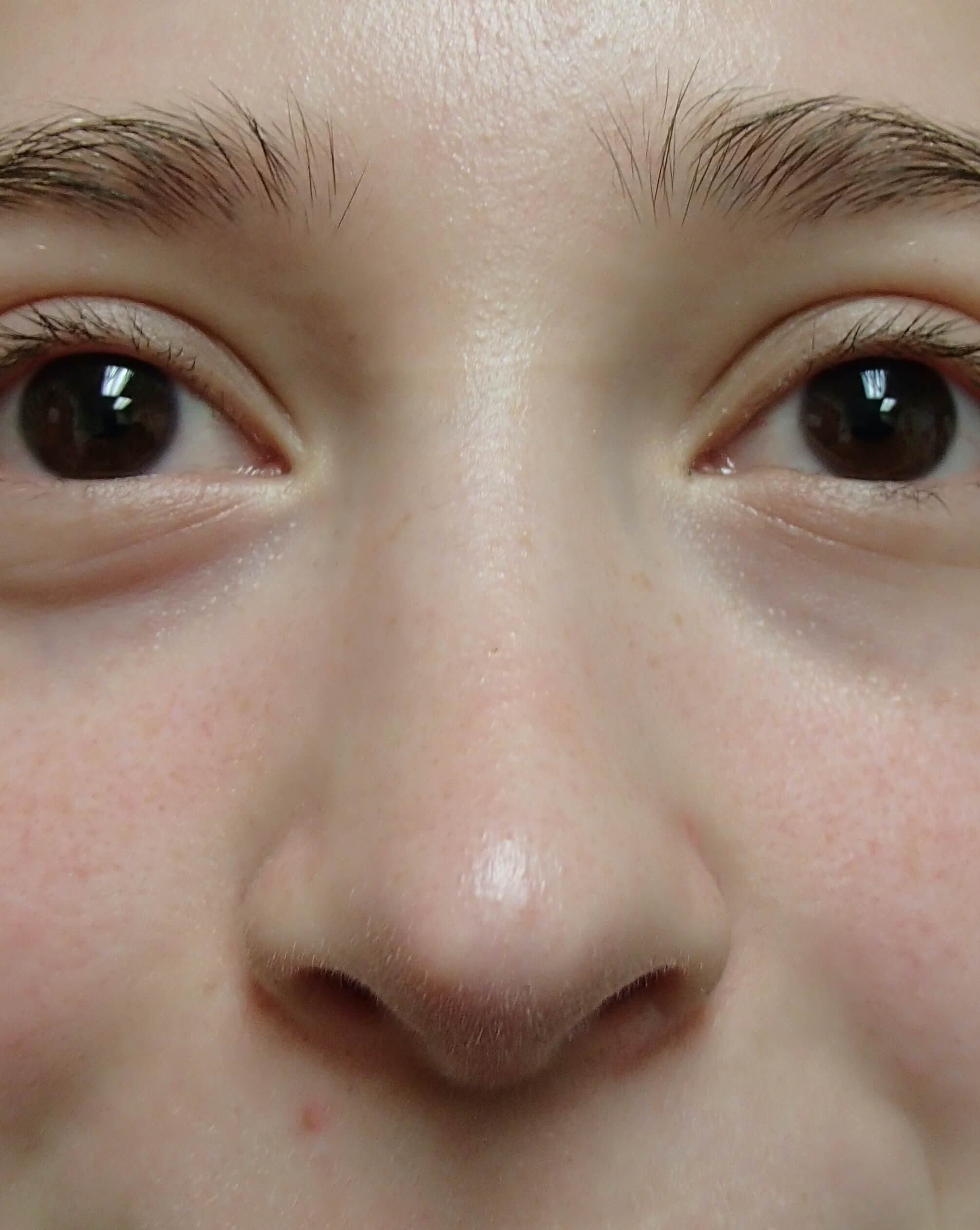 Rhinoplasty After