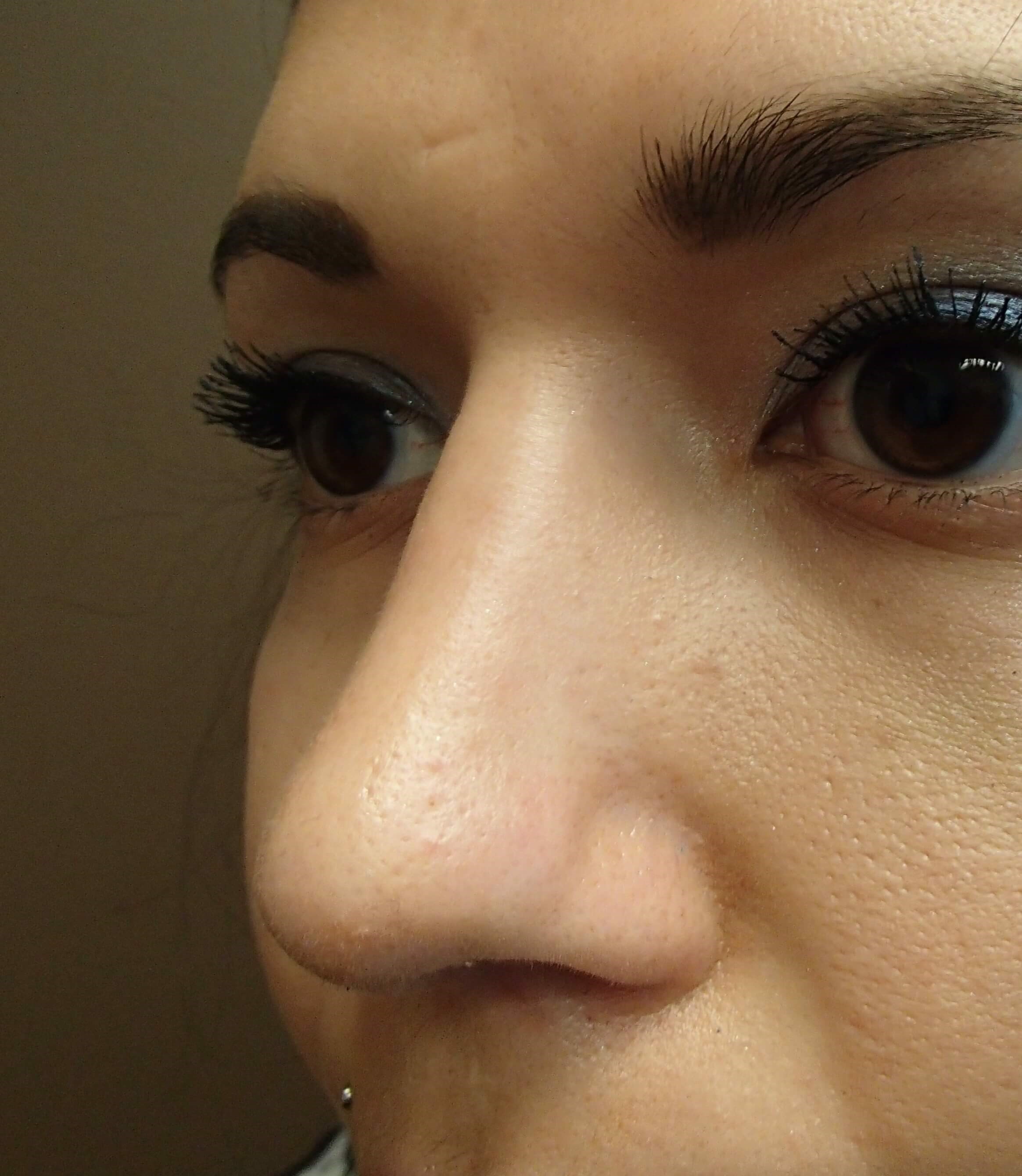 Rhinoplasty After