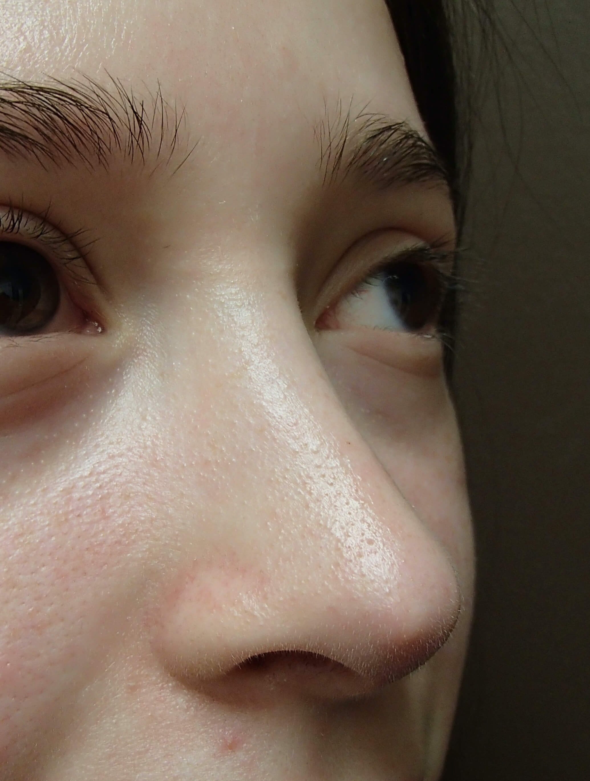 Rhinoplasty After