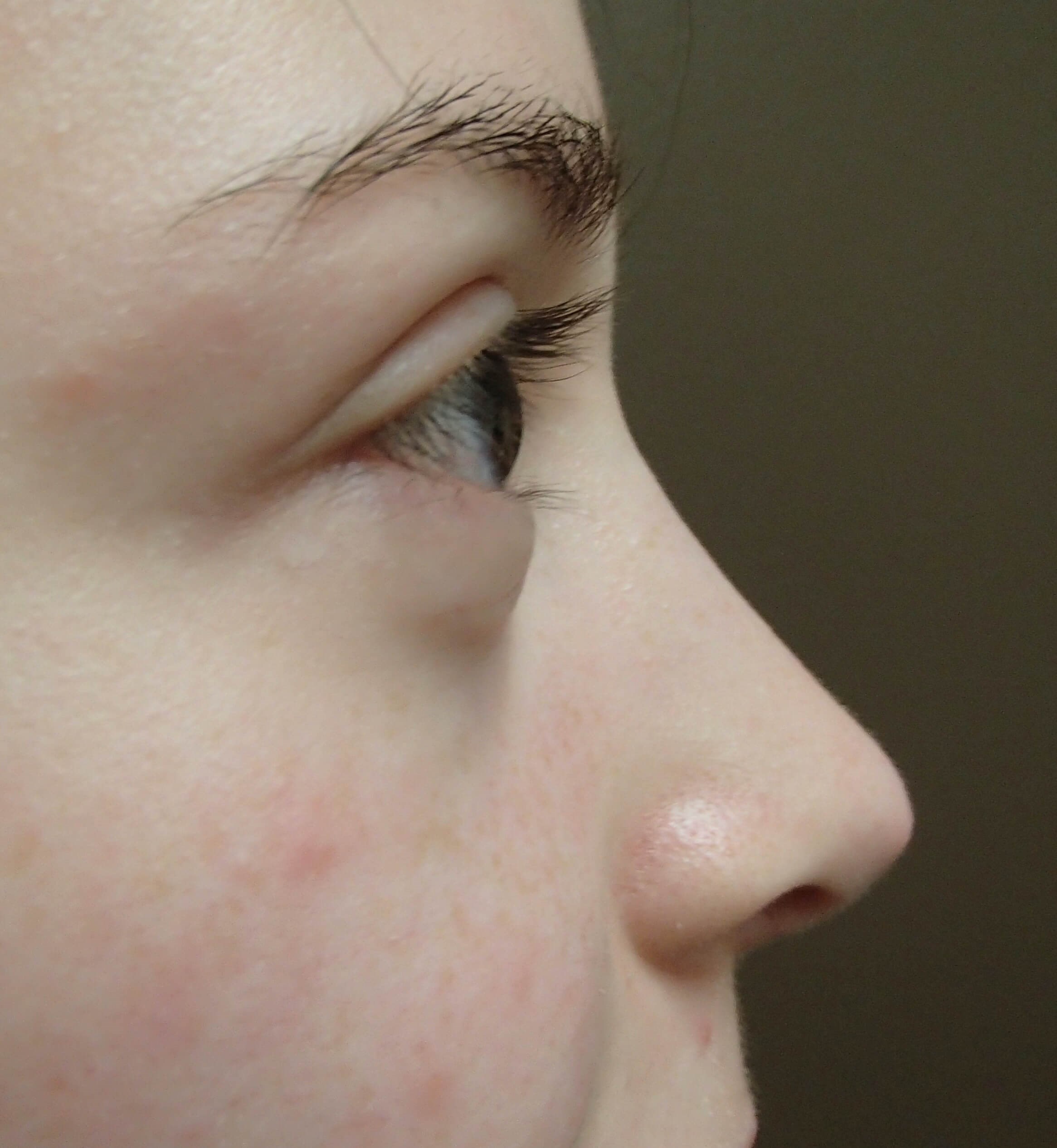 Rhinoplasty After