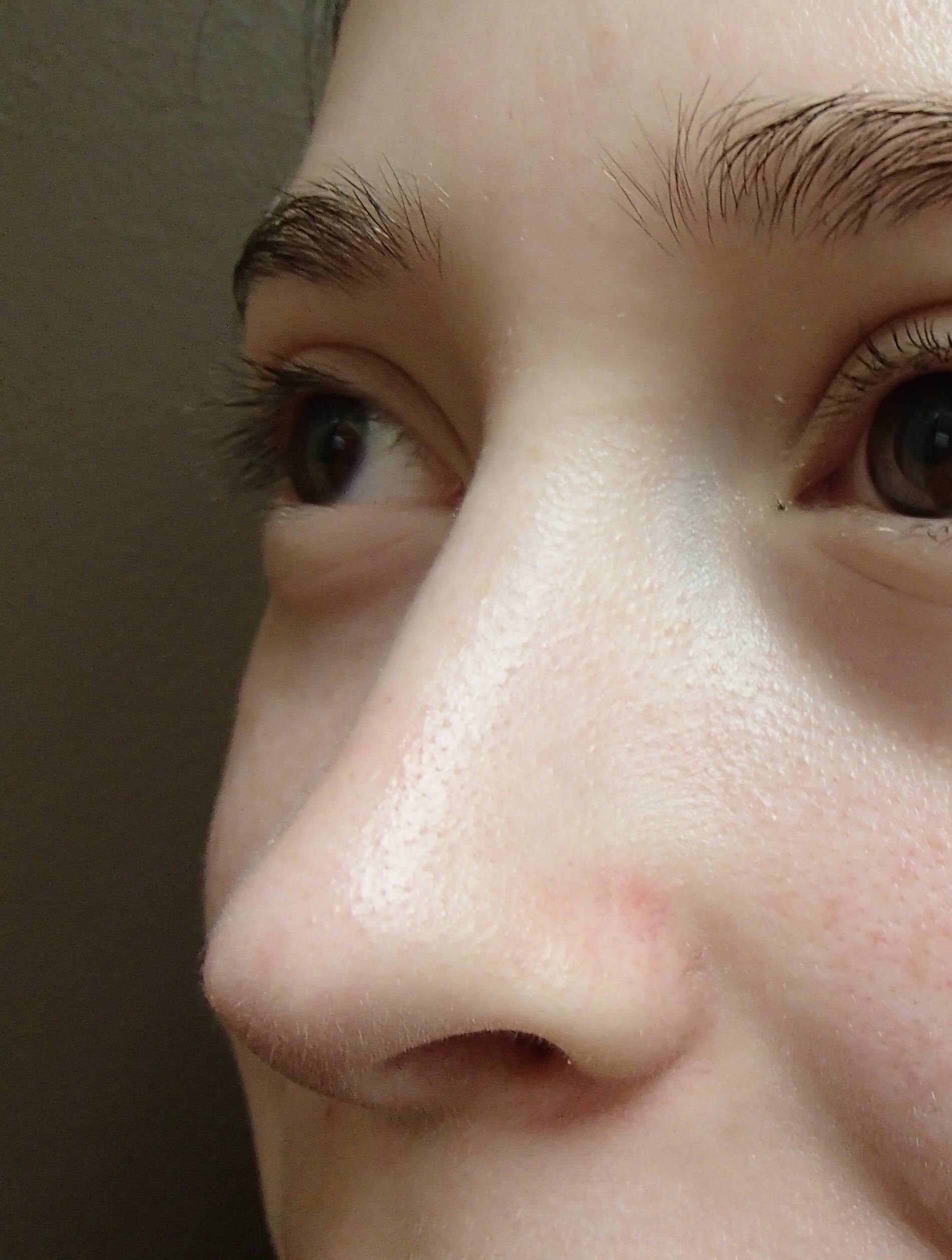 Rhinoplasty After