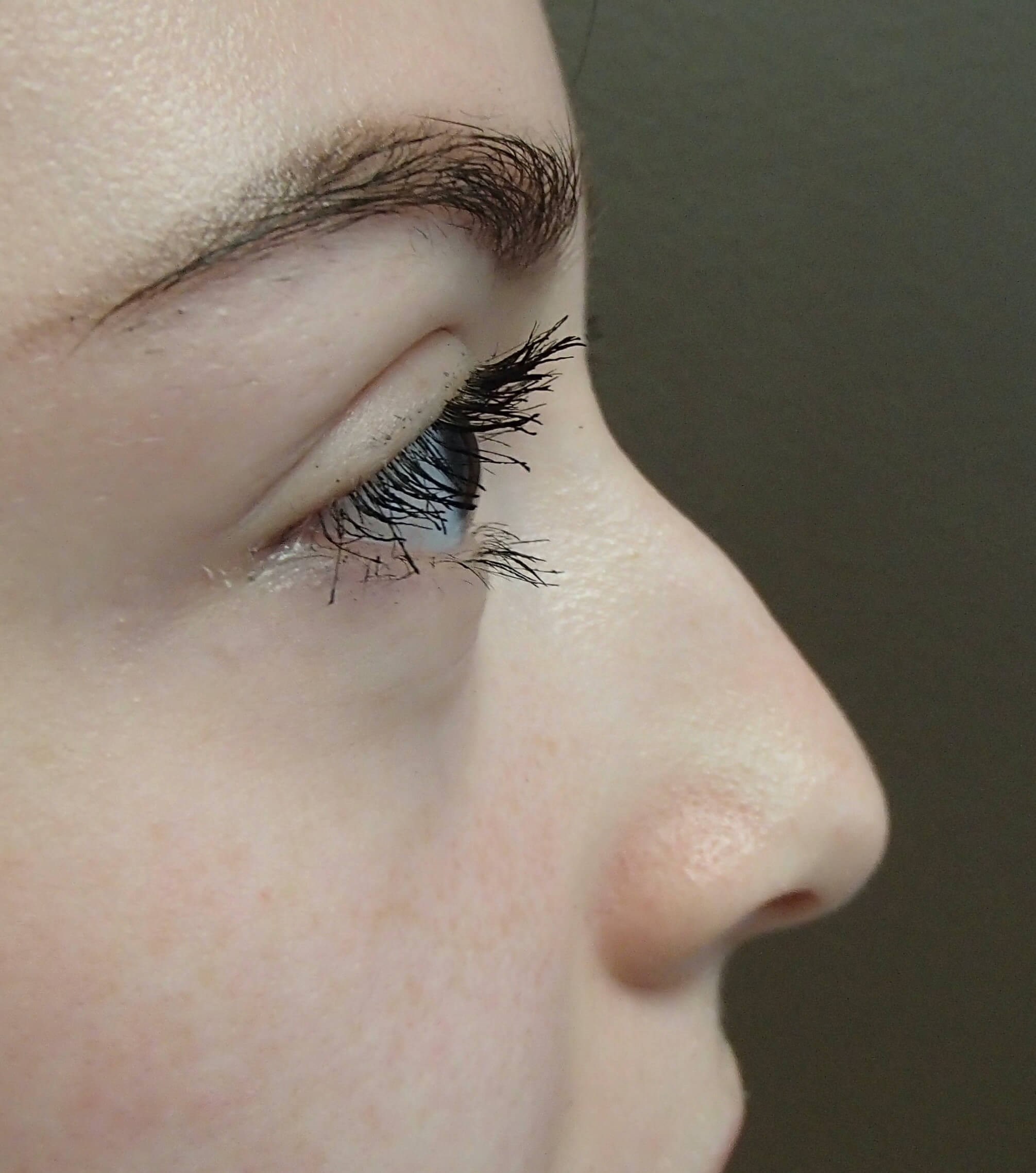 Rhinoplasty Before
