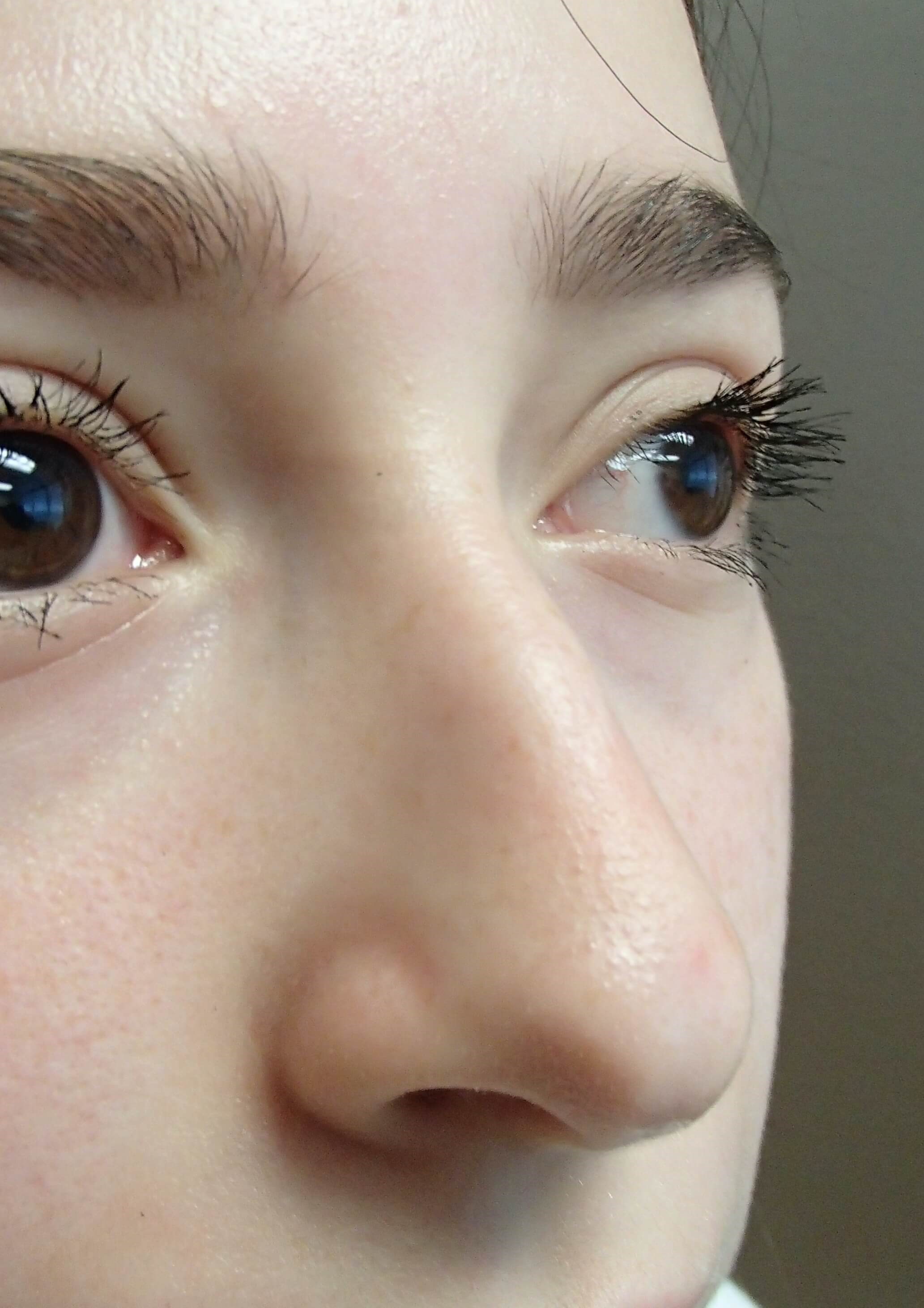 Rhinoplasty Before