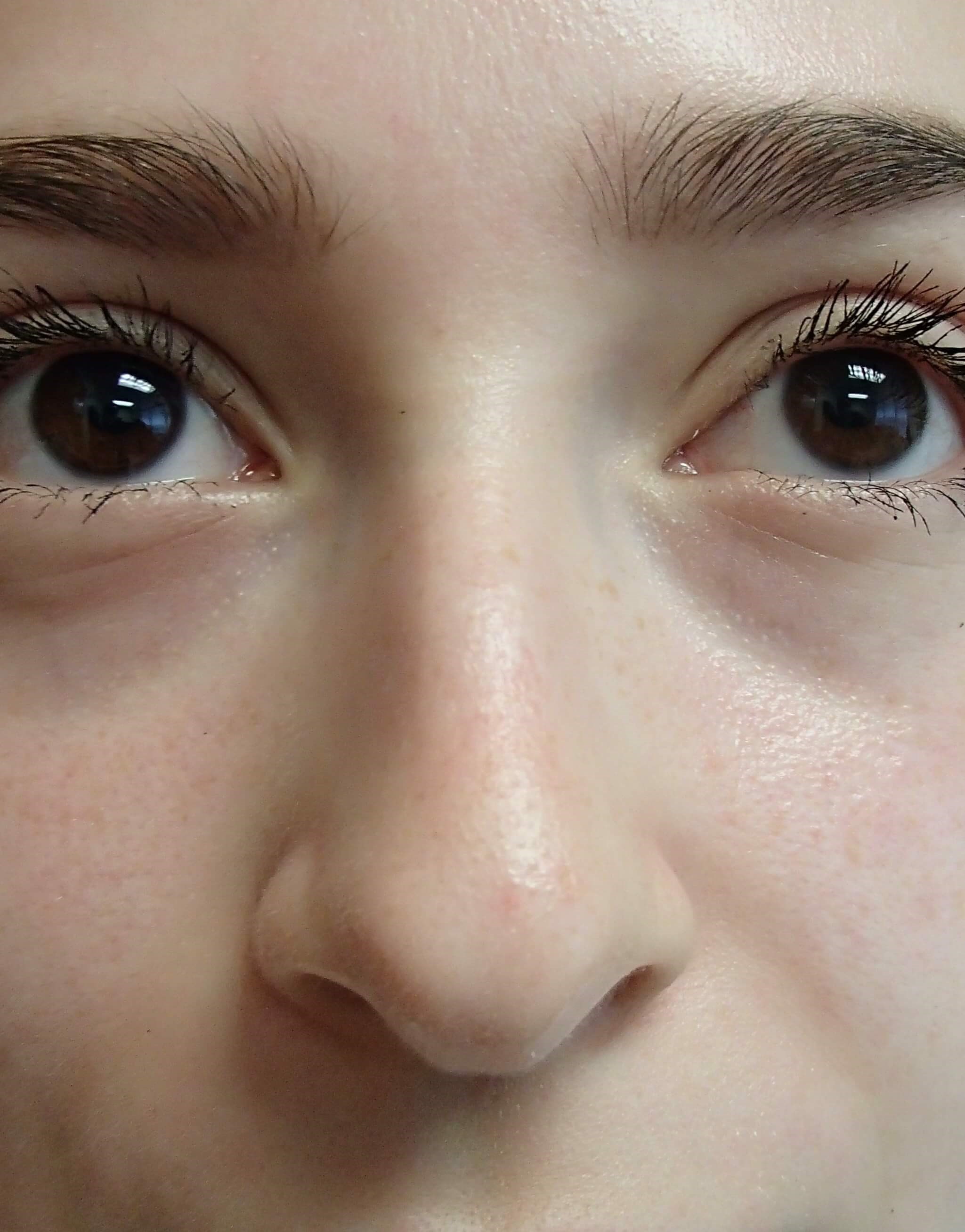 Rhinoplasty Before