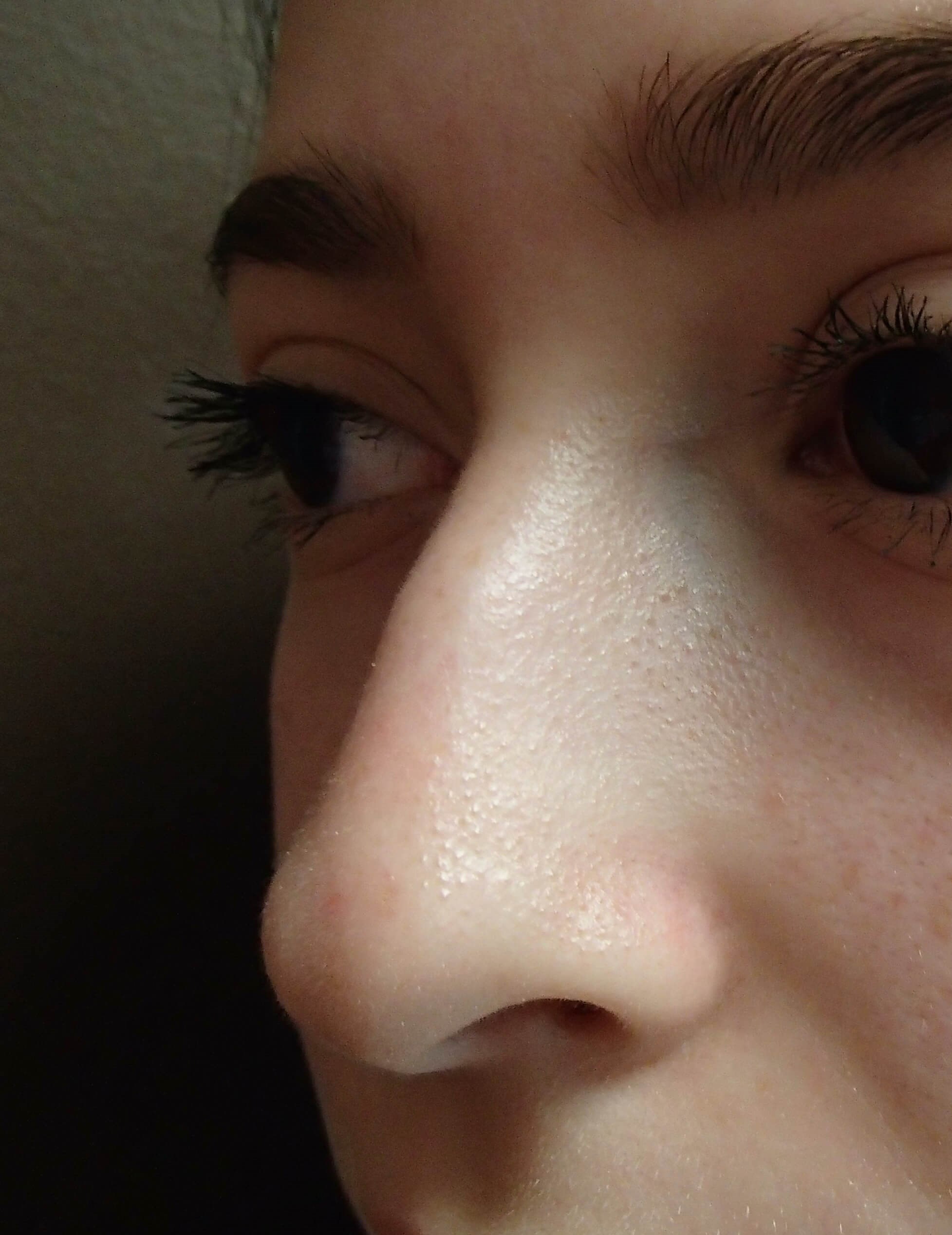 Rhinoplasty Before