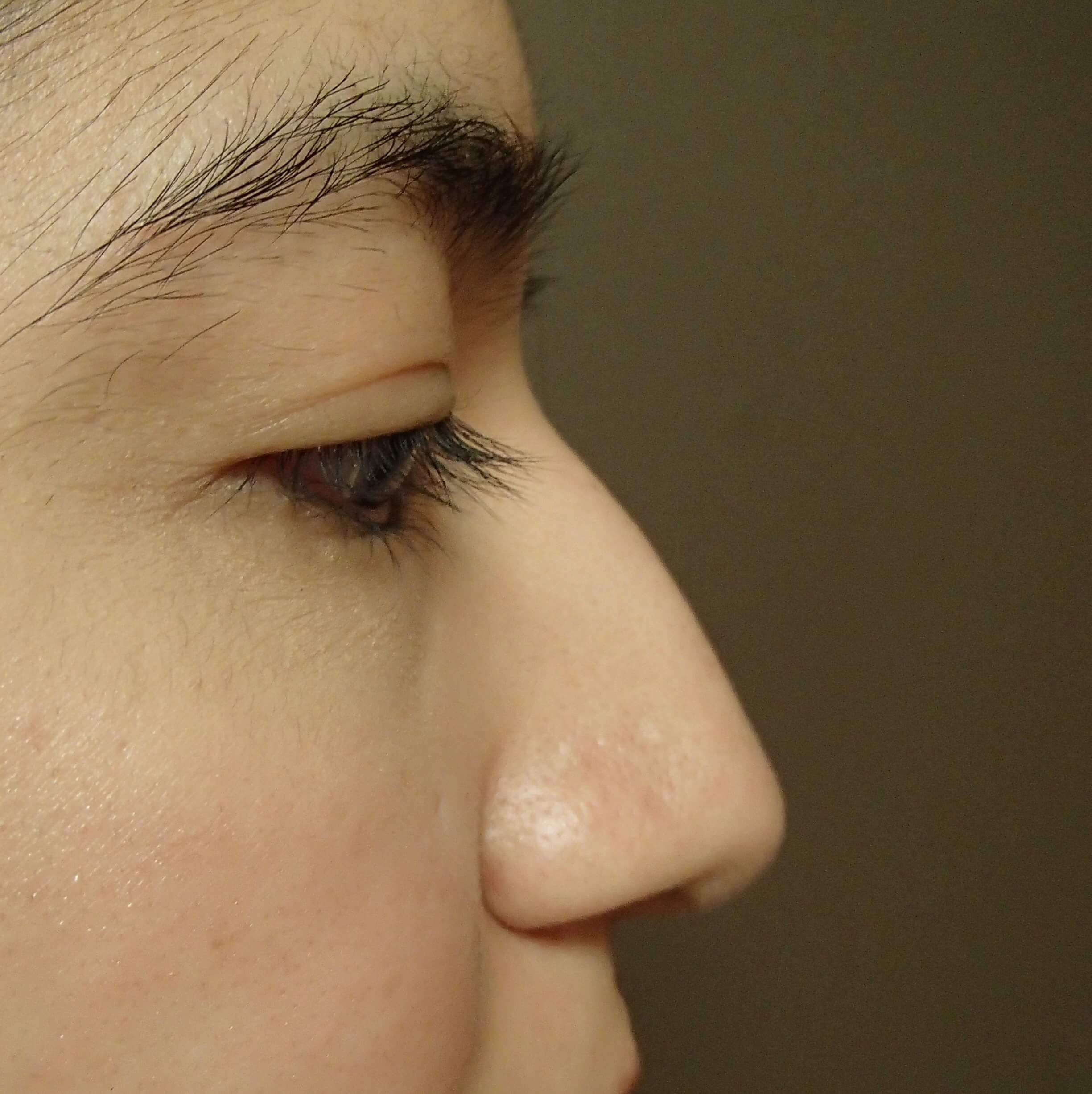 Rhinoplasty Before