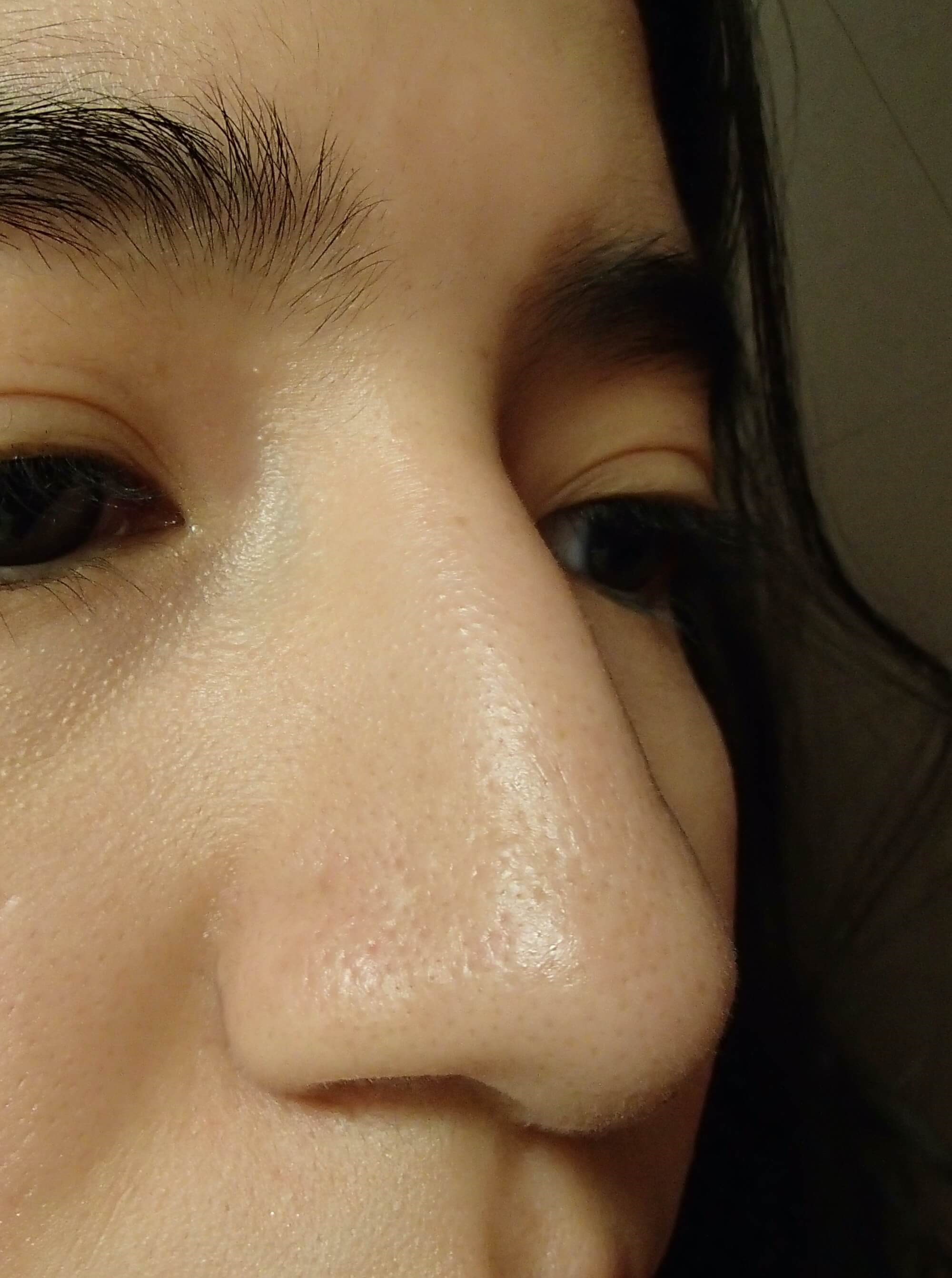 Rhinoplasty Before