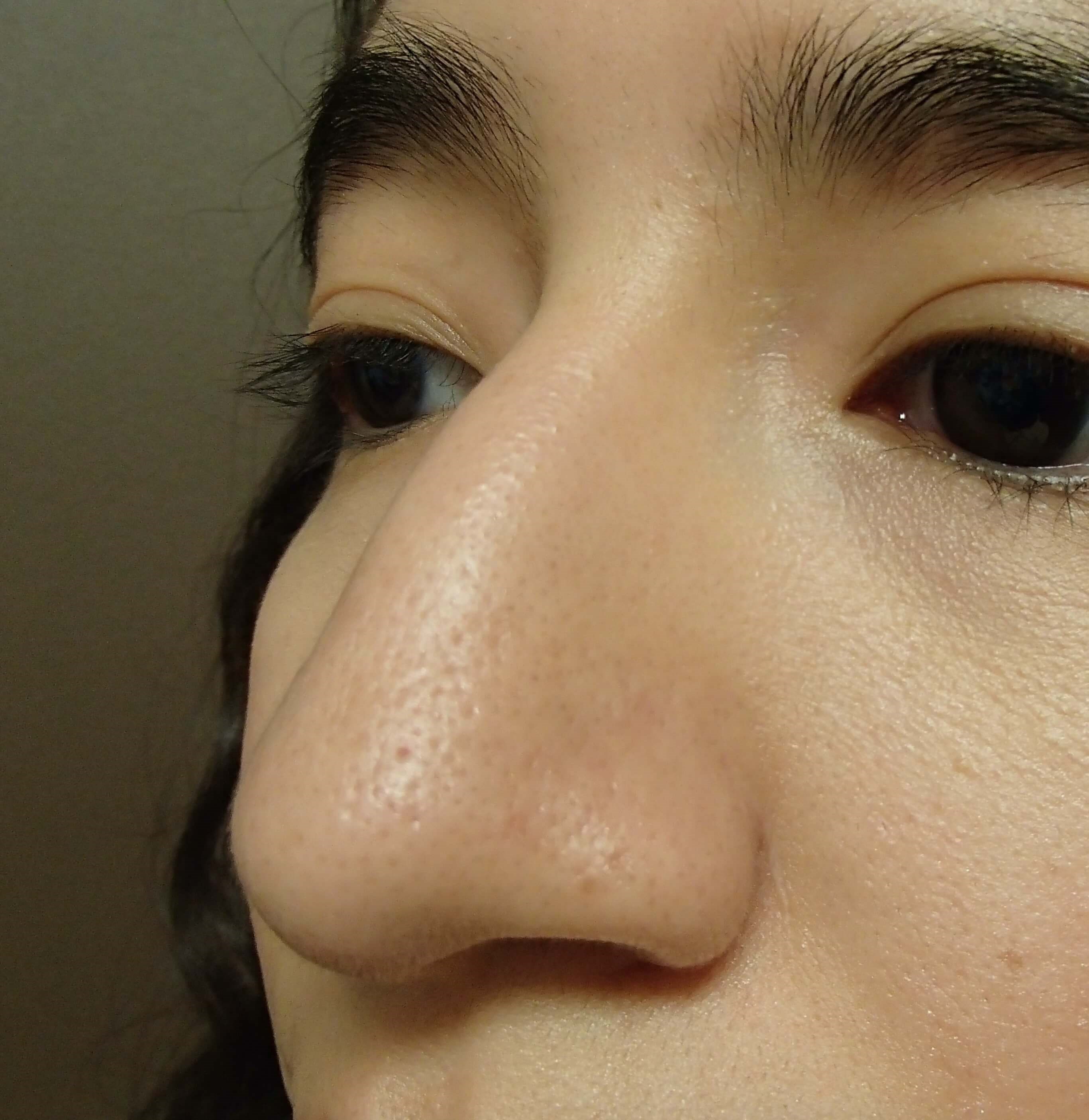 Rhinoplasty Before