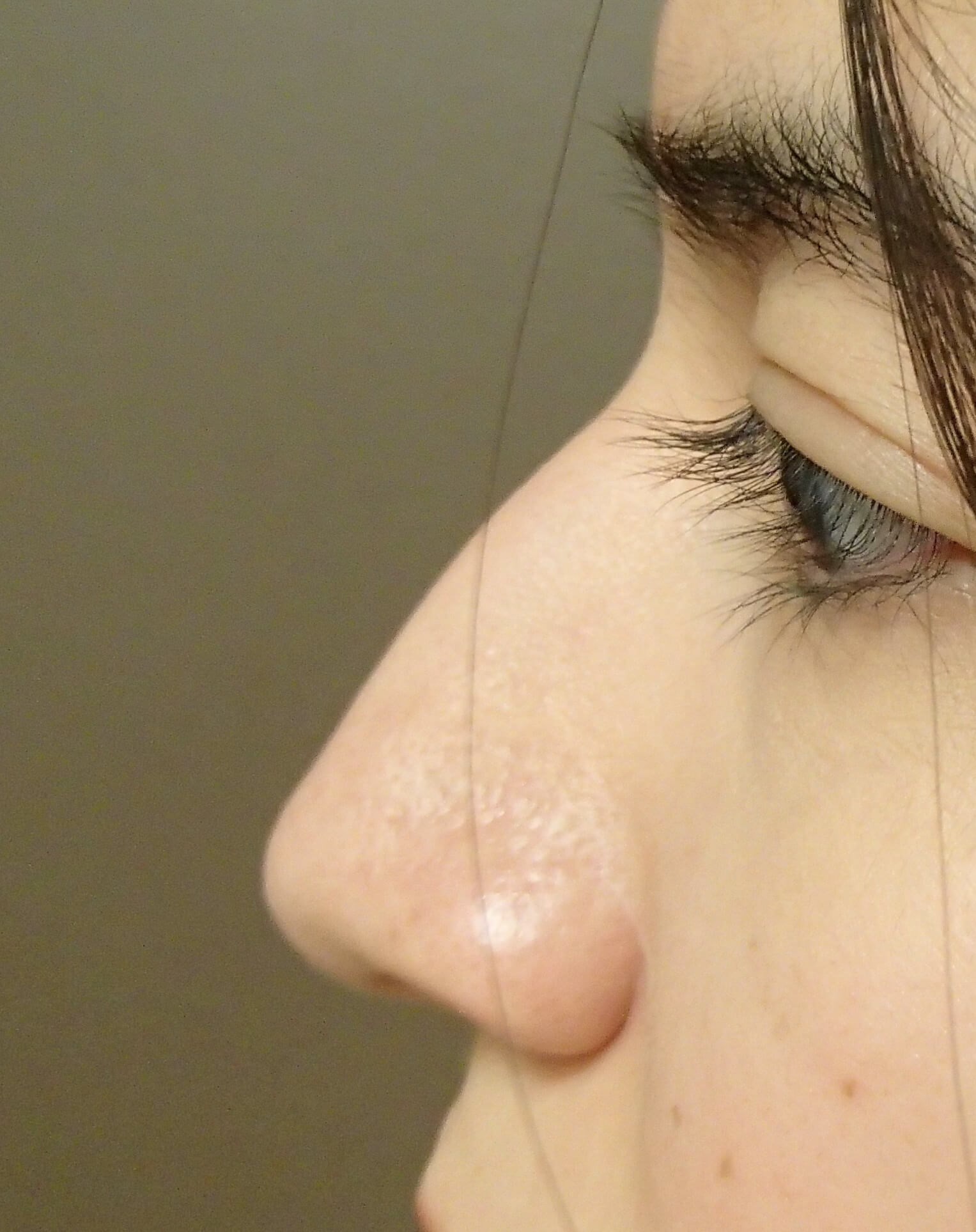 Rhinoplasty Before