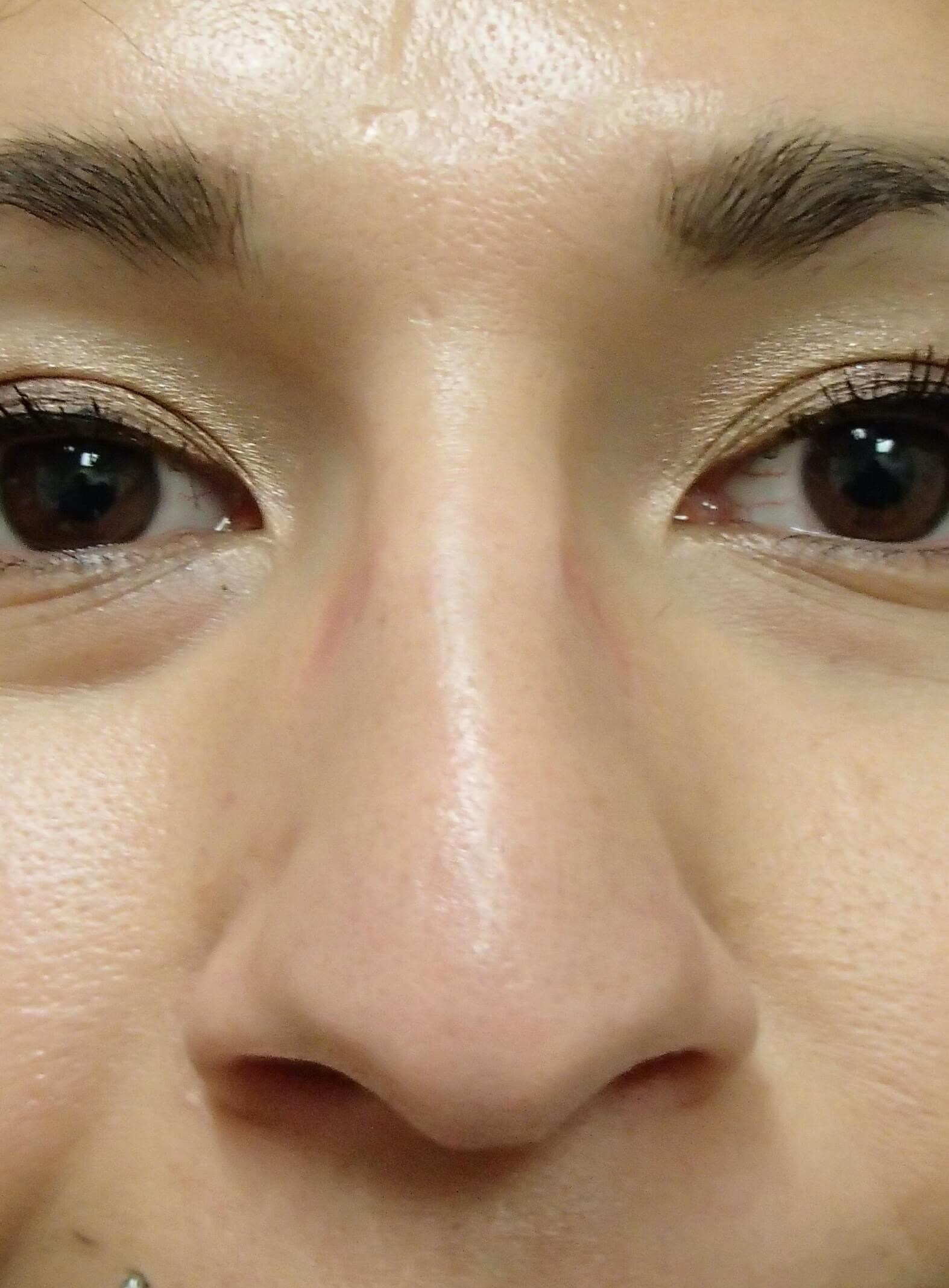 Rhinoplasty Before