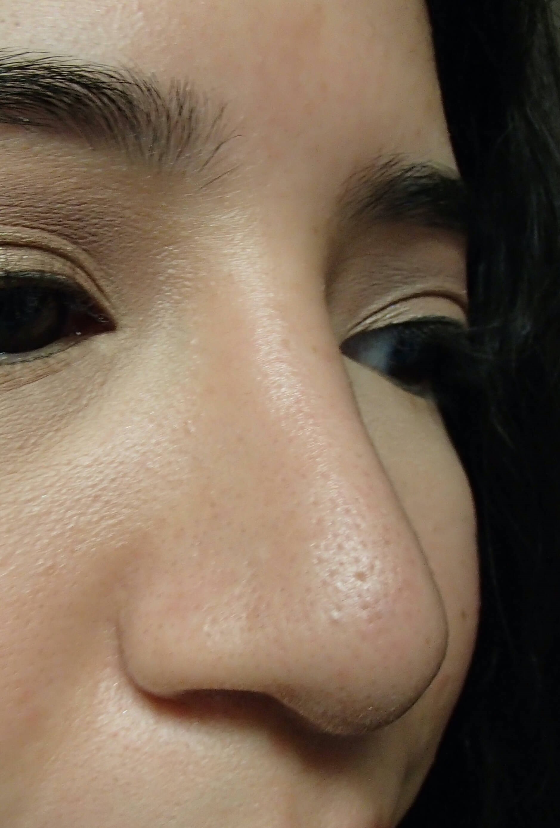 Rhinoplasty After