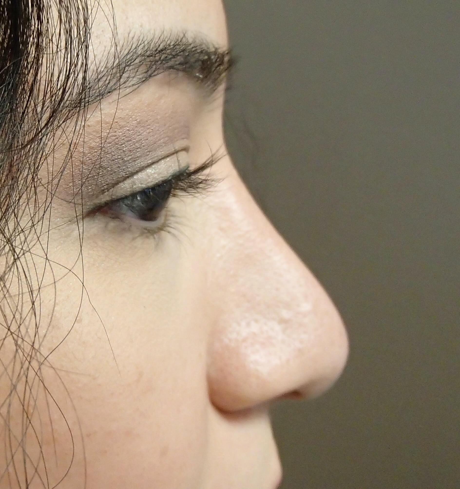 Rhinoplasty After