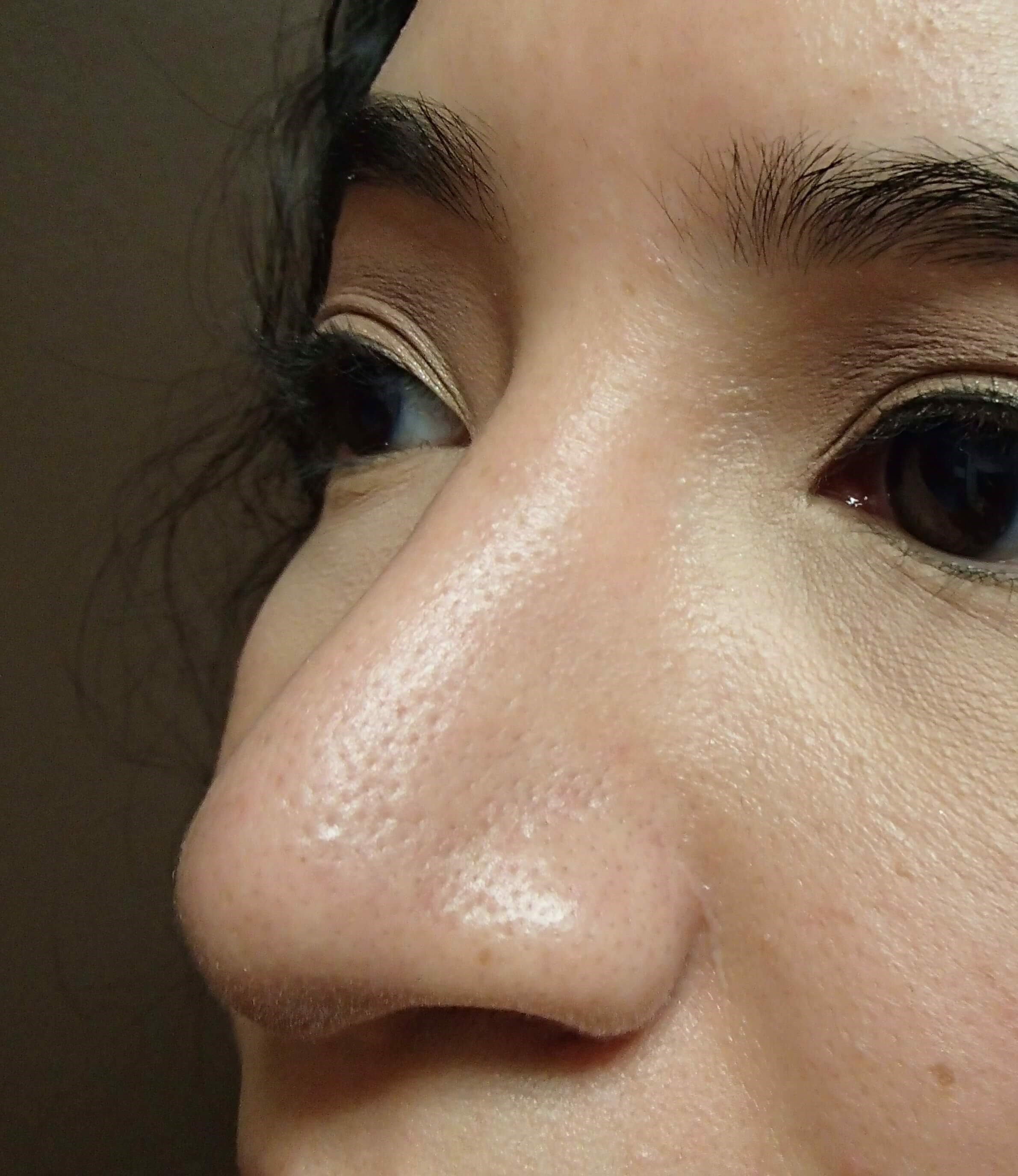 Rhinoplasty After
