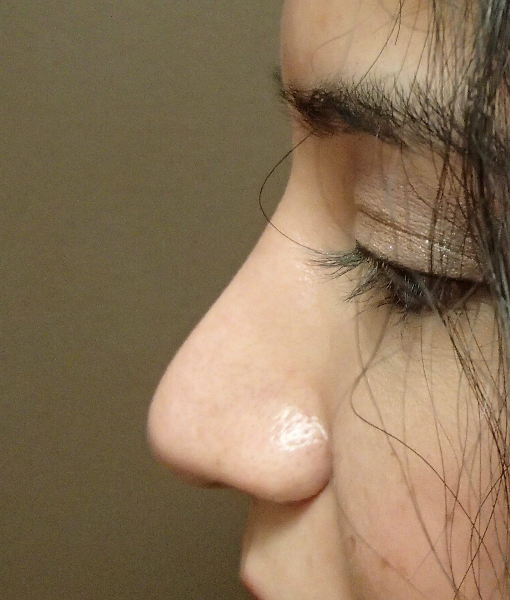 Rhinoplasty After