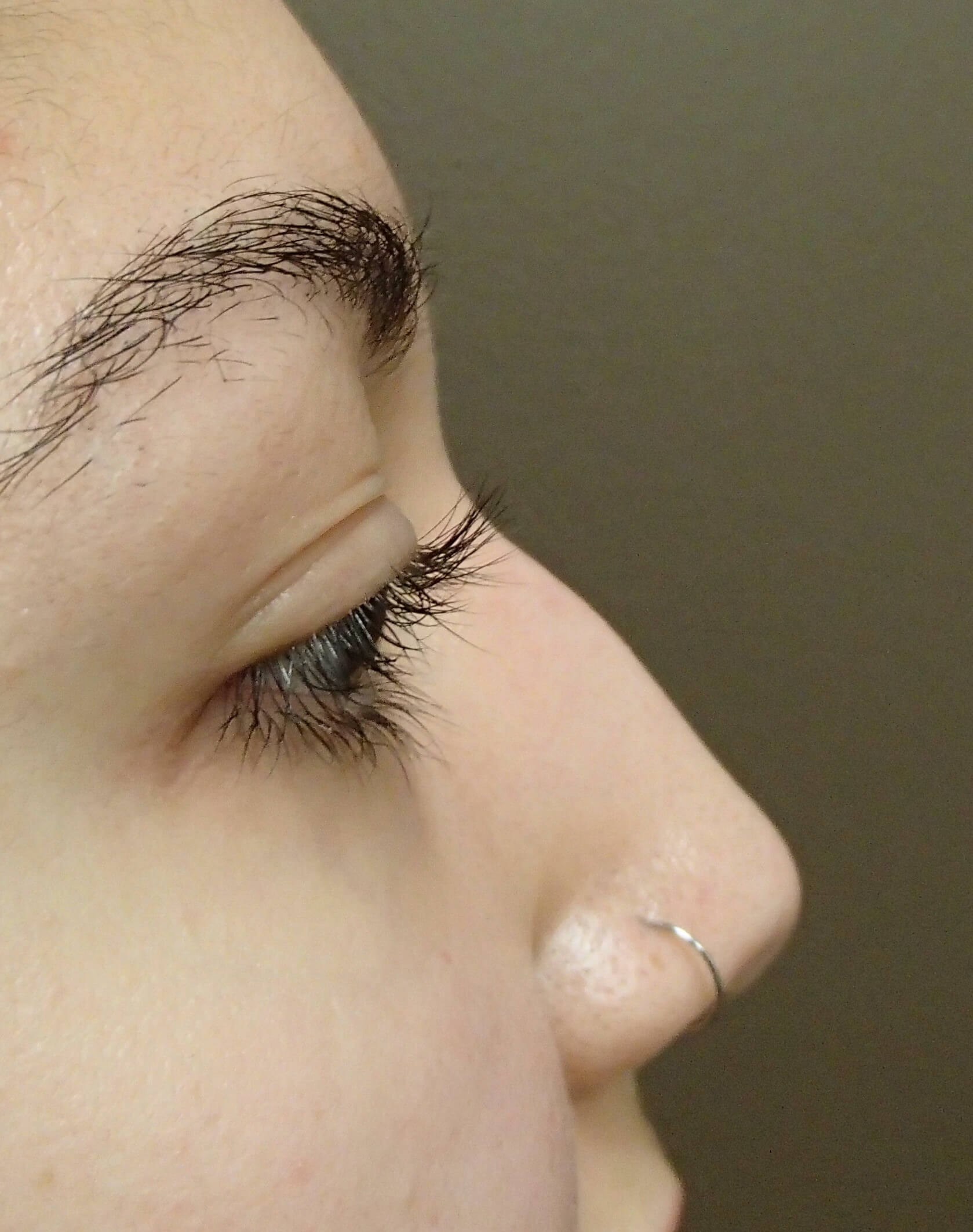 Rhinoplasty Before