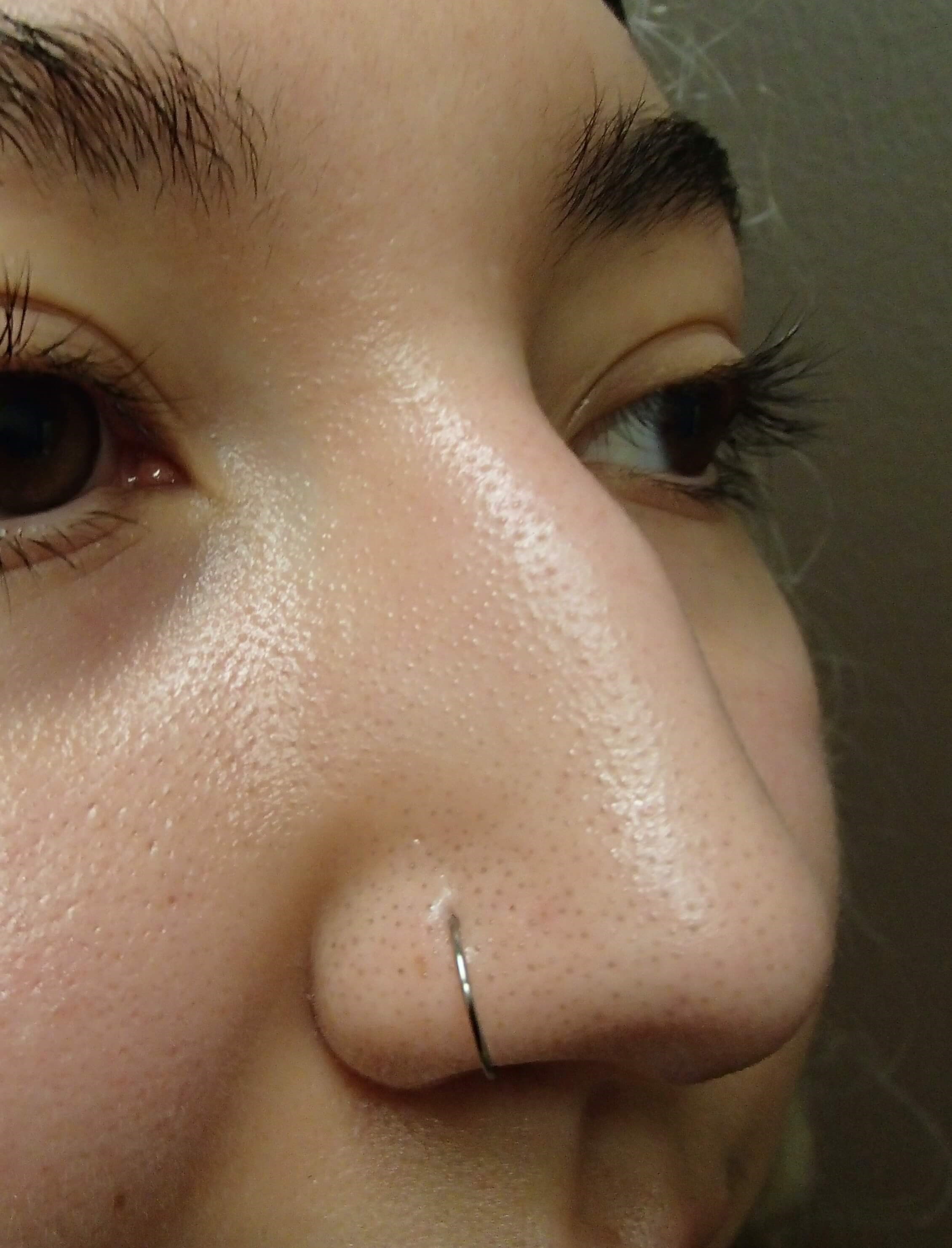 Rhinoplasty Before