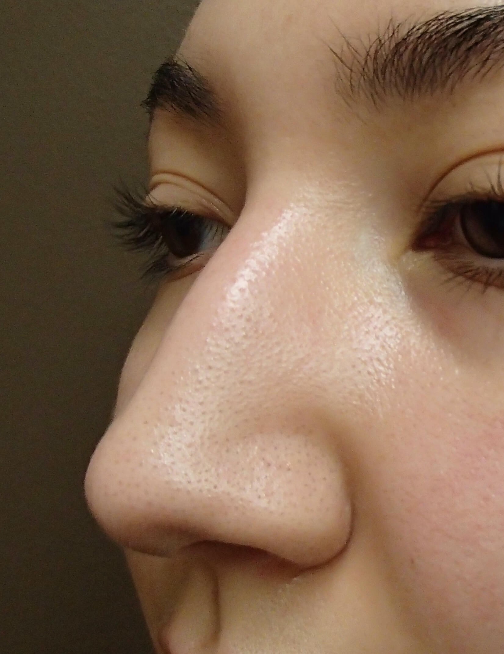 Rhinoplasty Before