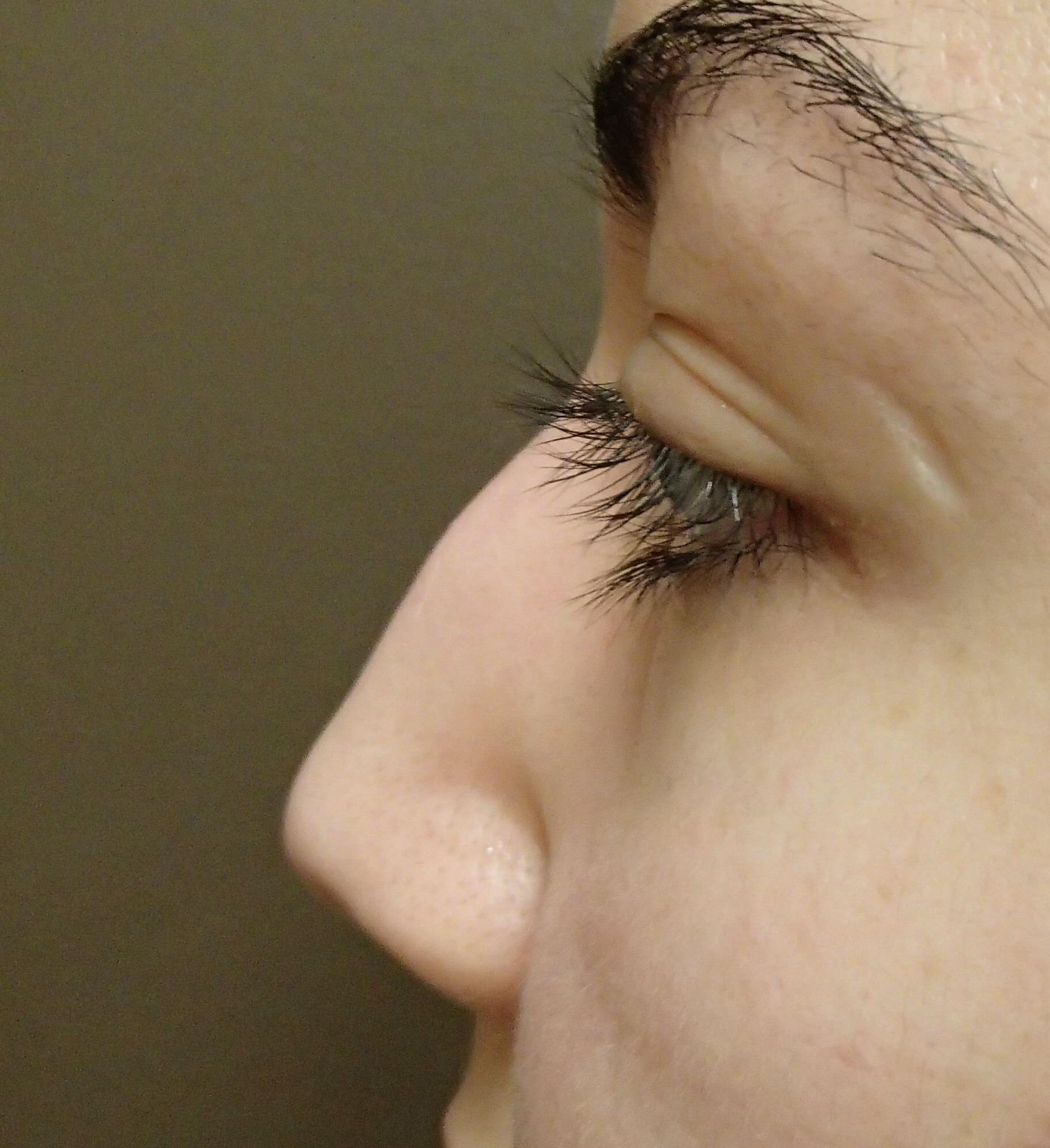 Rhinoplasty Before