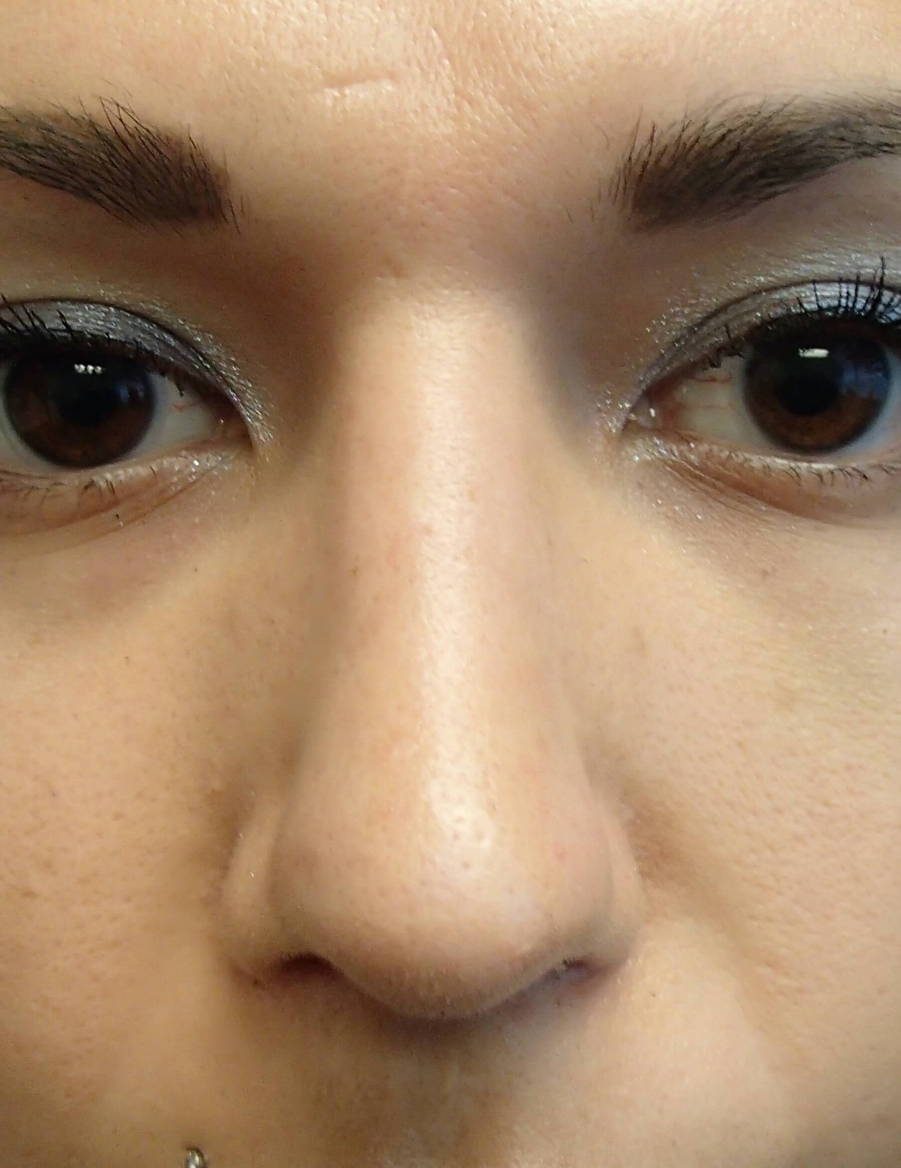 Rhinoplasty After