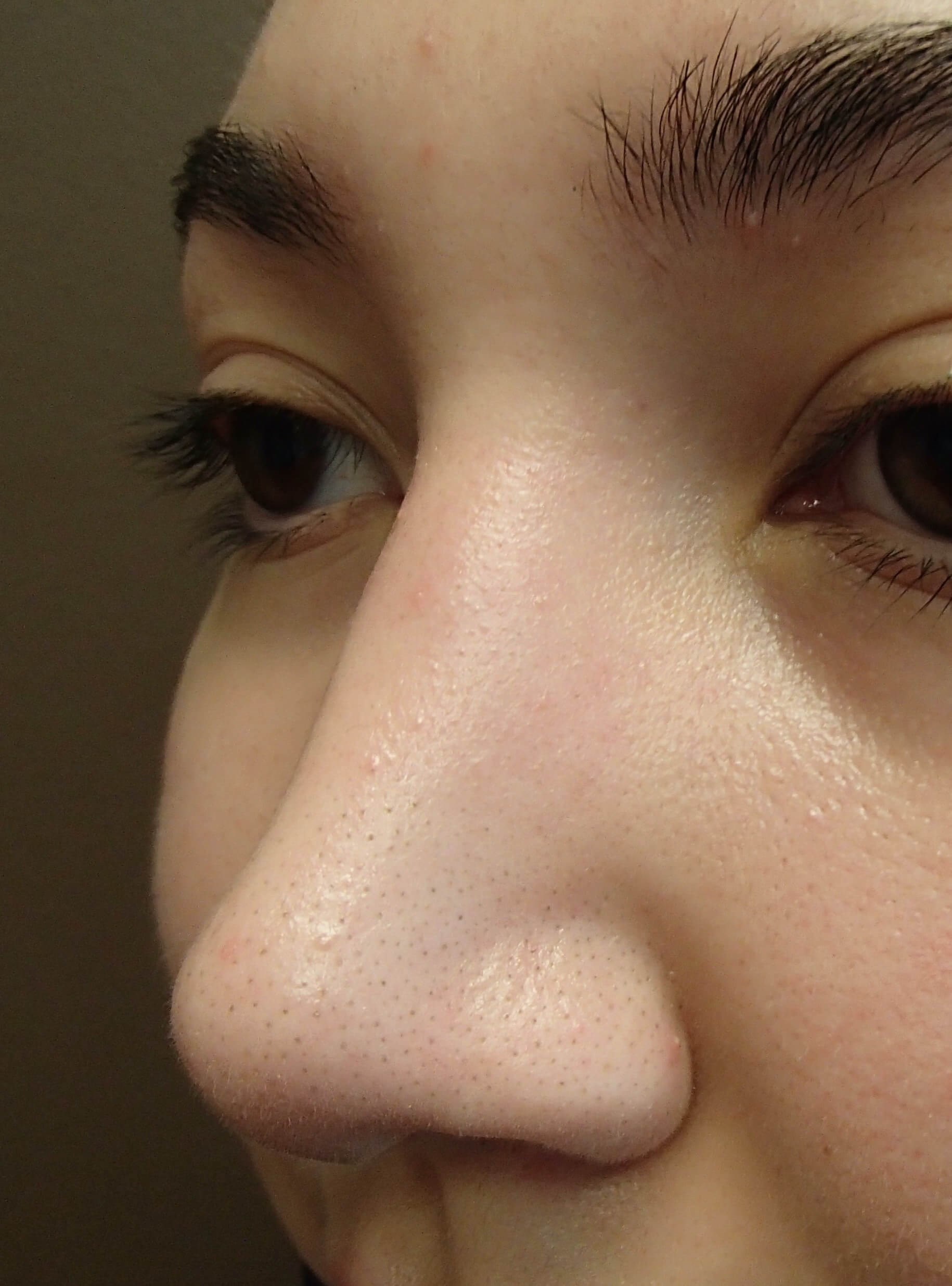 Rhinoplasty After