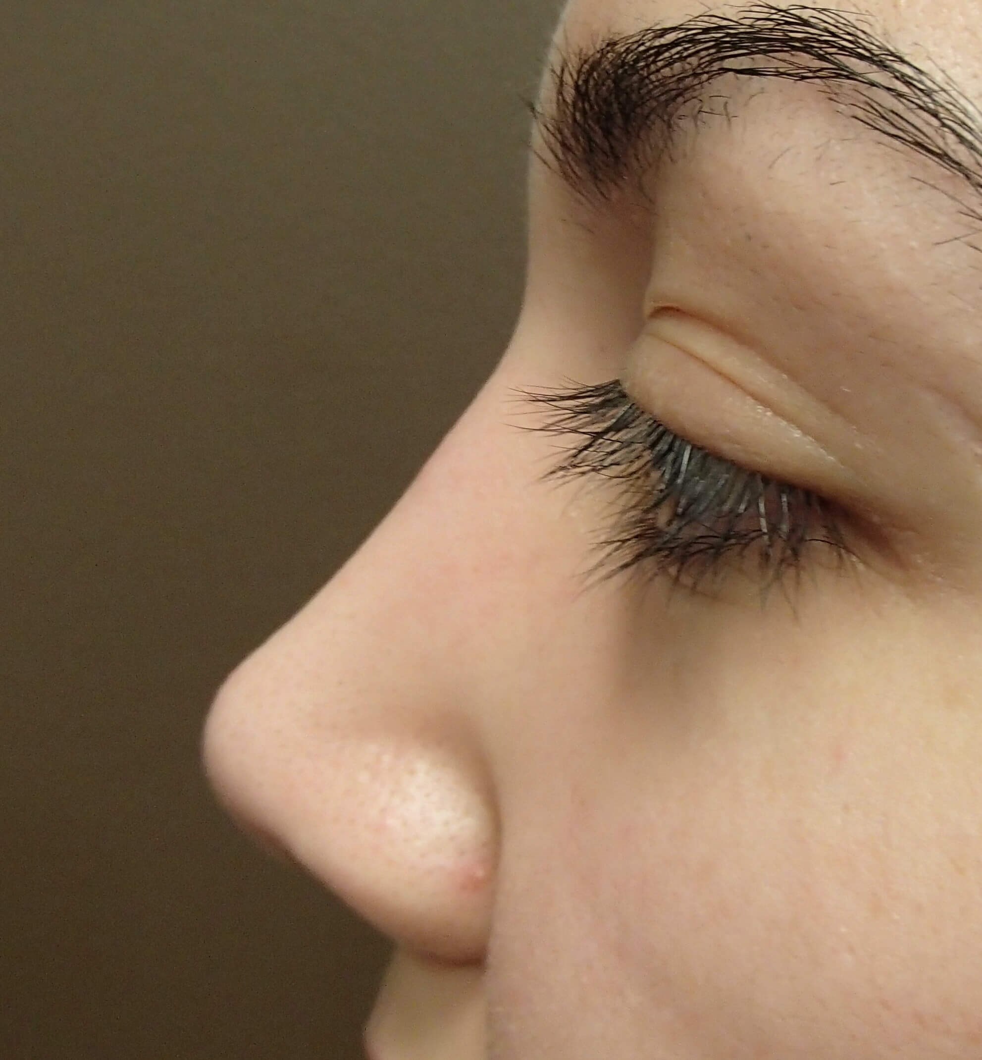 Rhinoplasty After