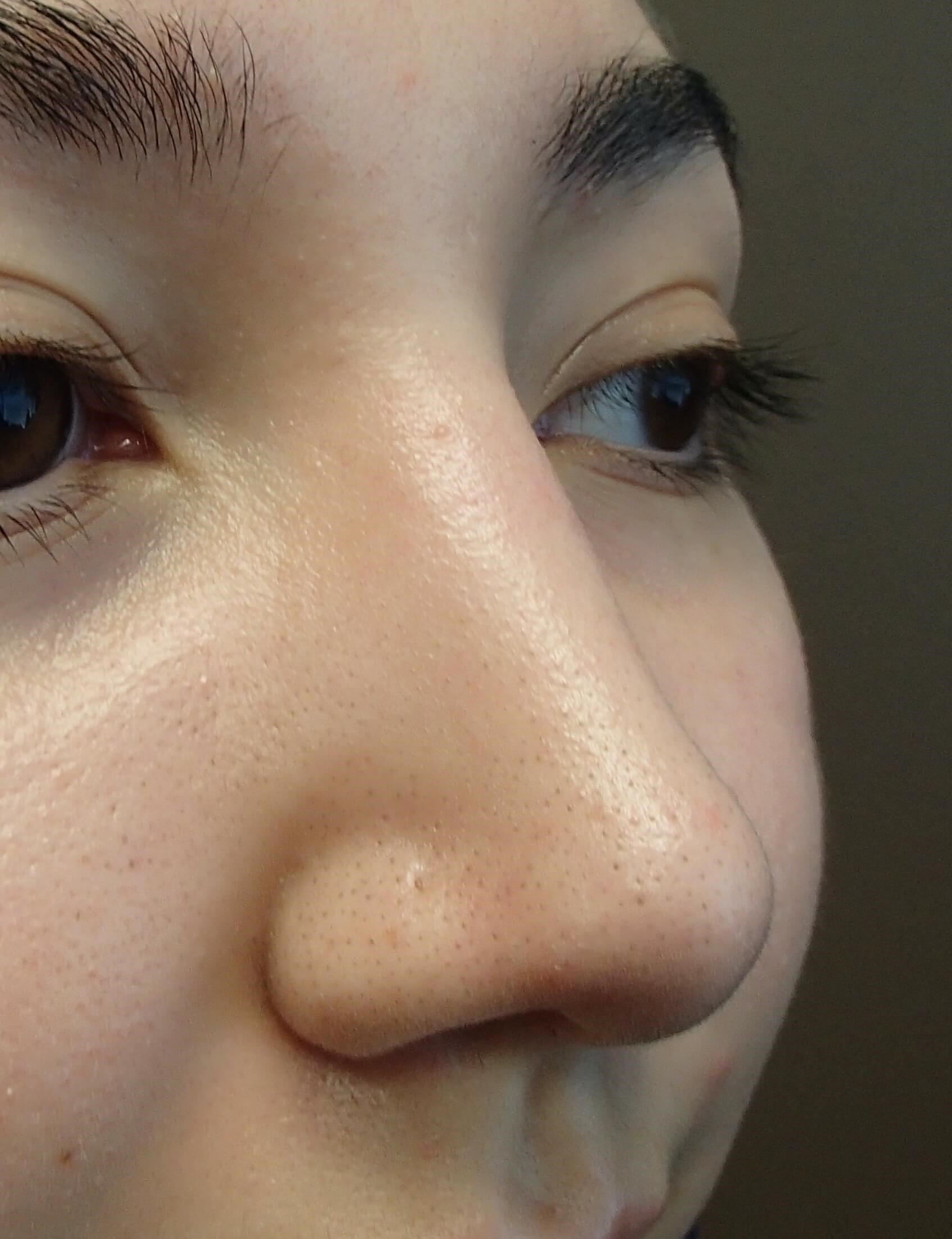Rhinoplasty After
