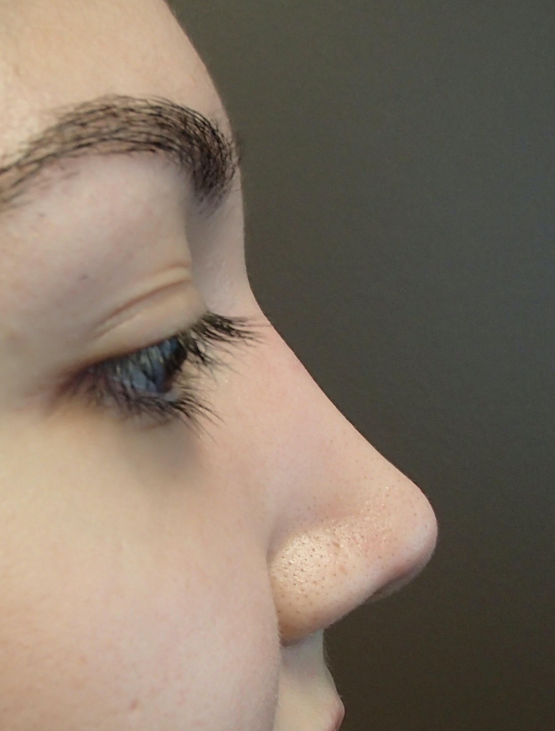 Rhinoplasty After
