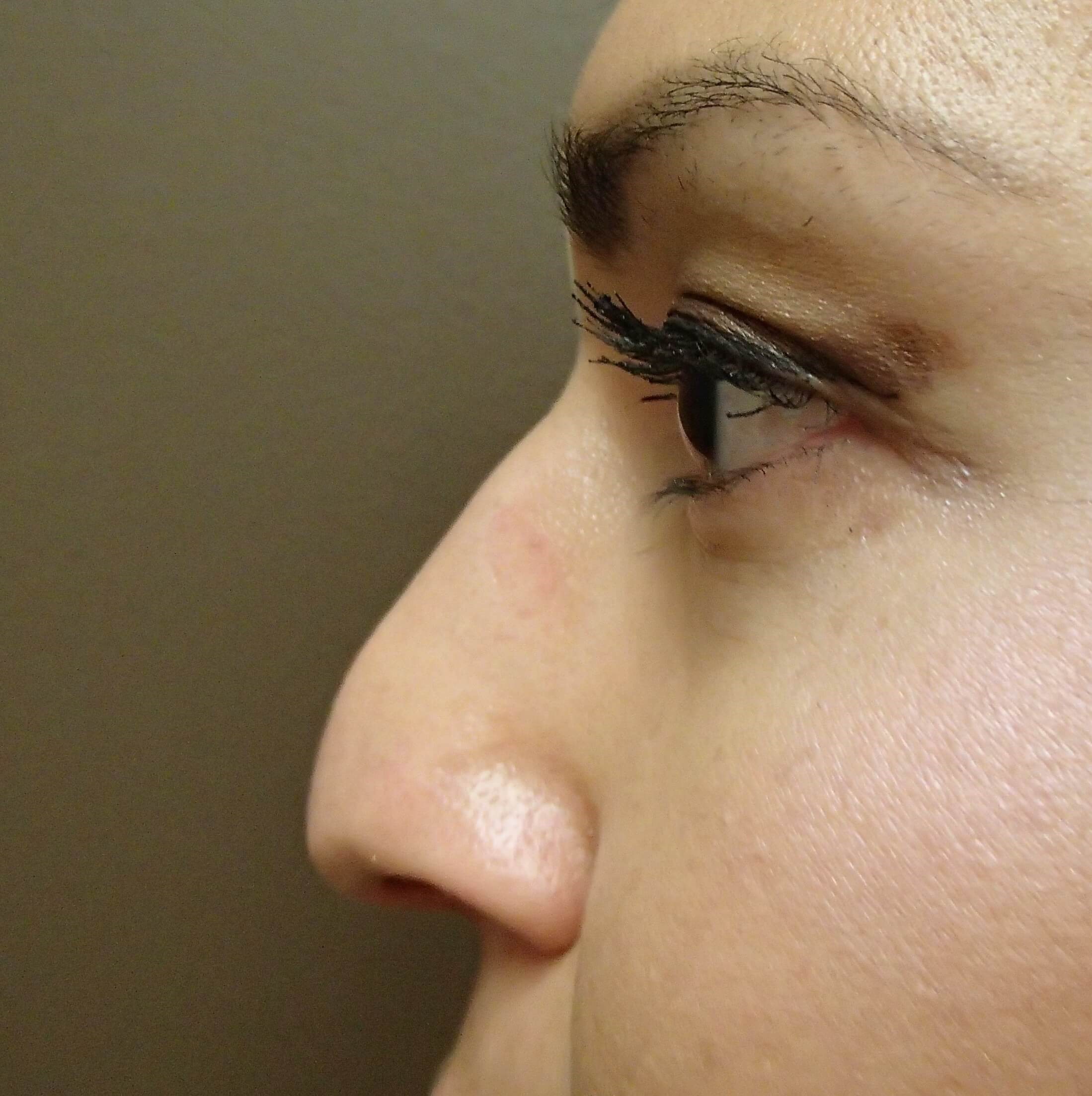 Rhinoplasty Before