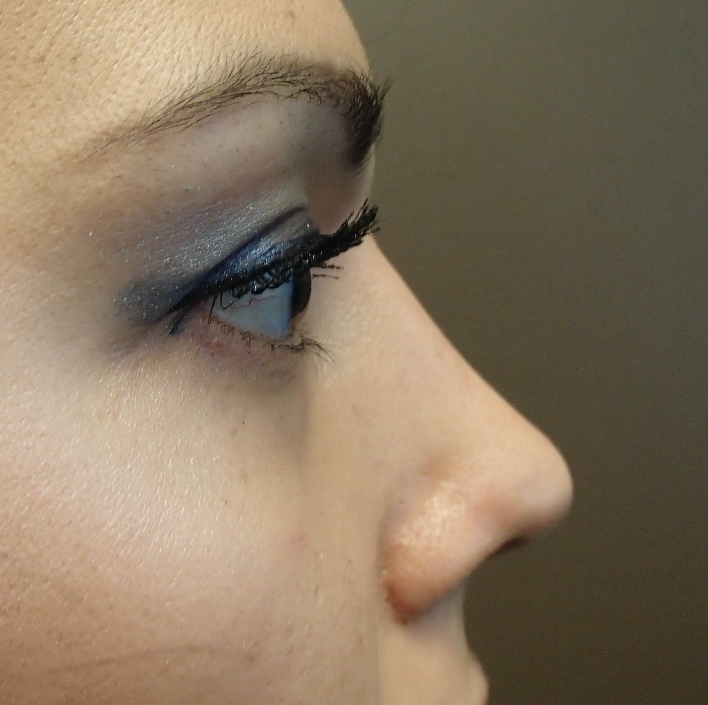 Rhinoplasty After