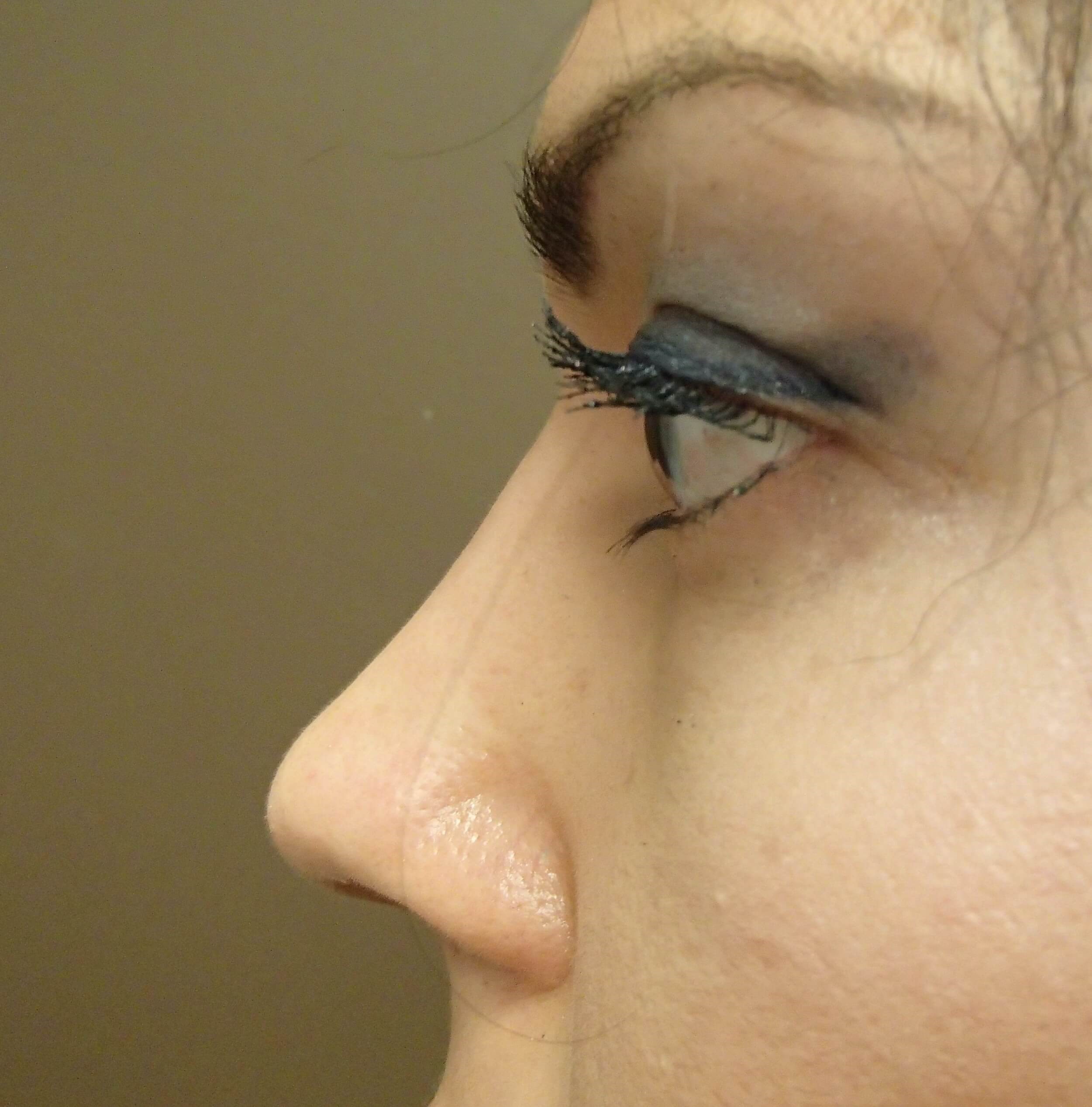 Rhinoplasty After