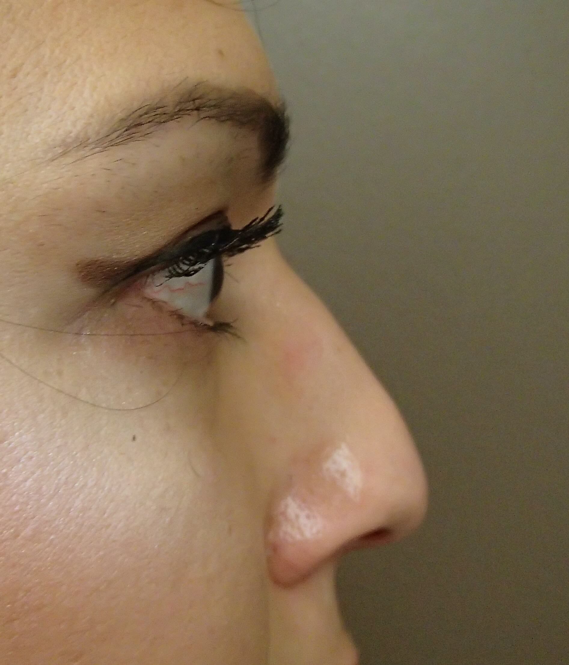 Rhinoplasty Before
