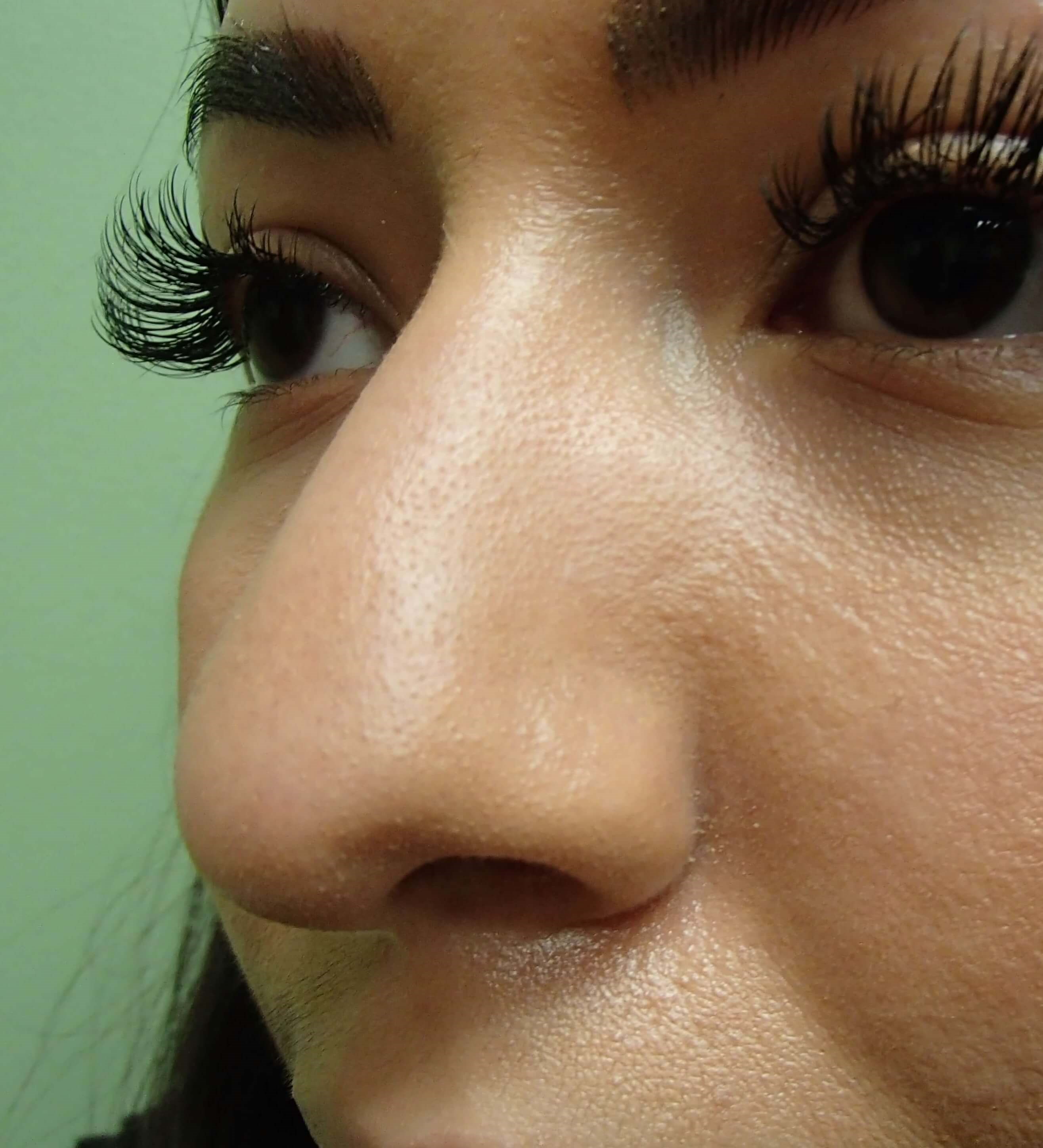 Rhinoplasty Before