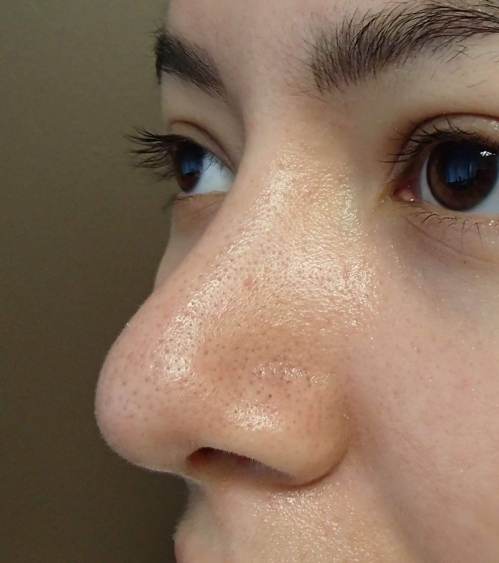 Rhinoplasty After