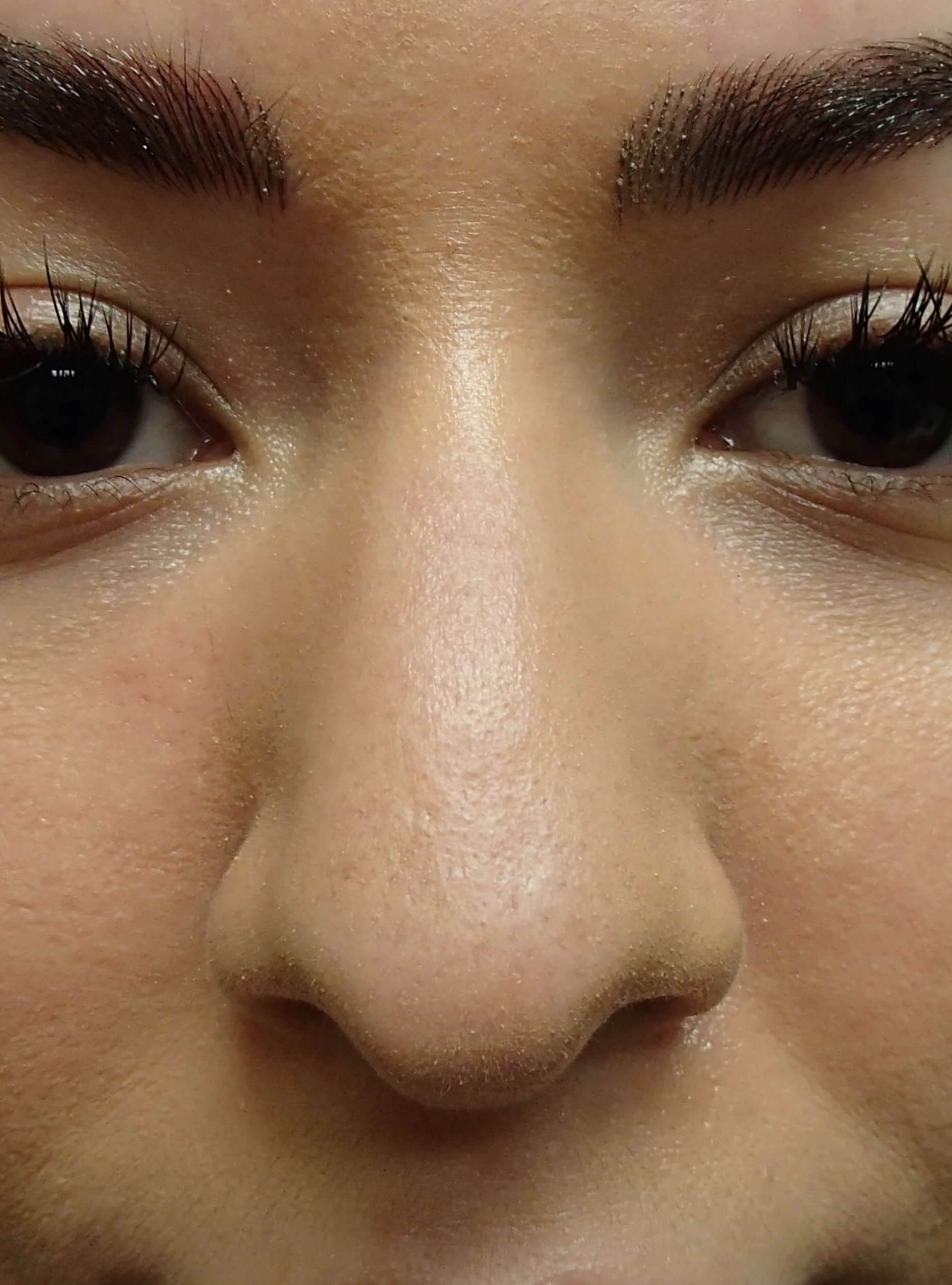 Rhinoplasty Before