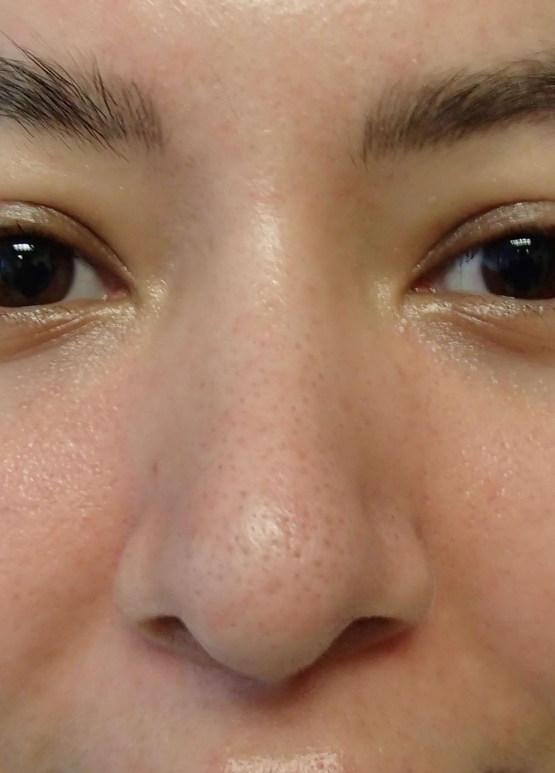 Rhinoplasty After
