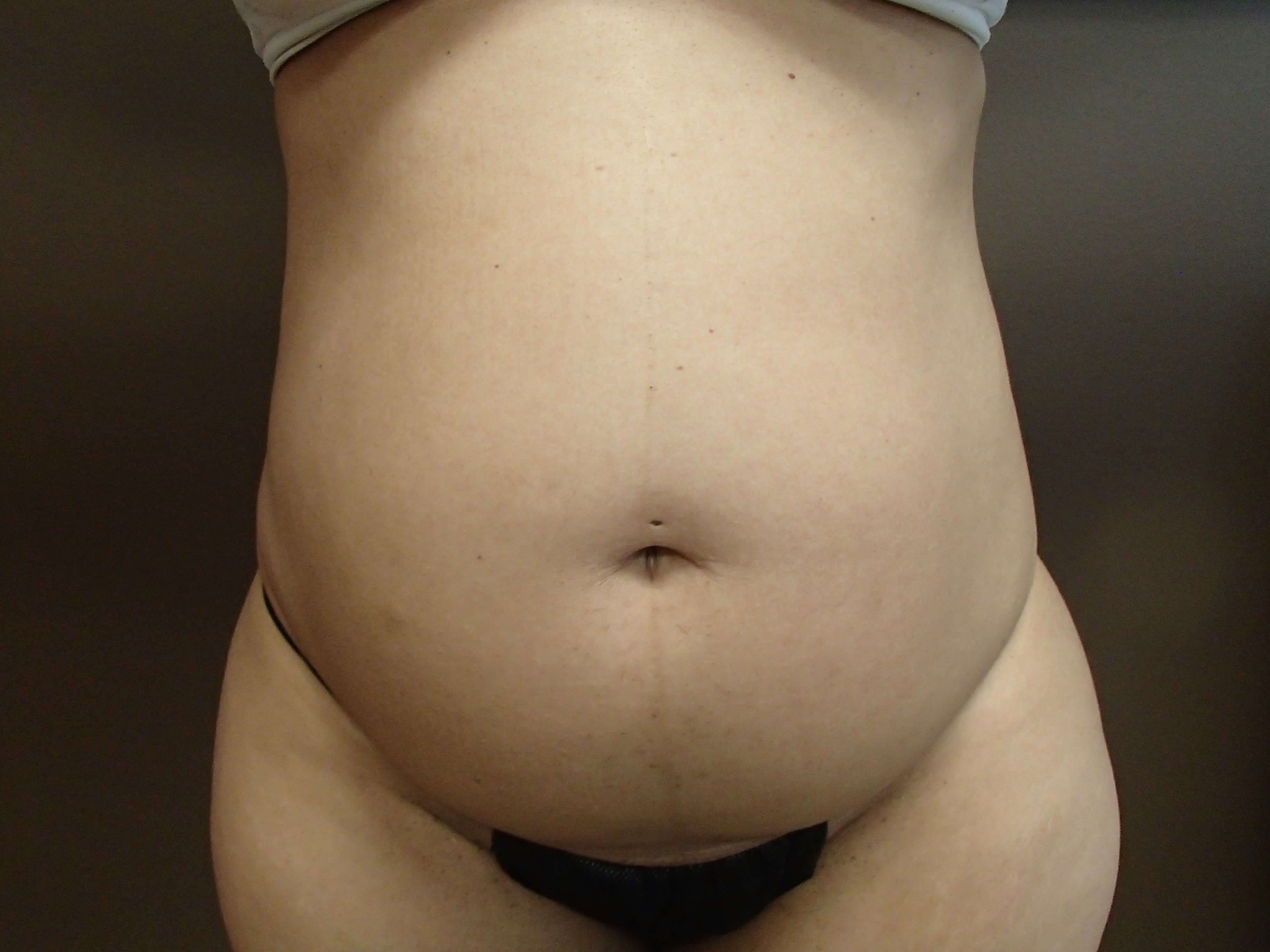 Liposuction Before