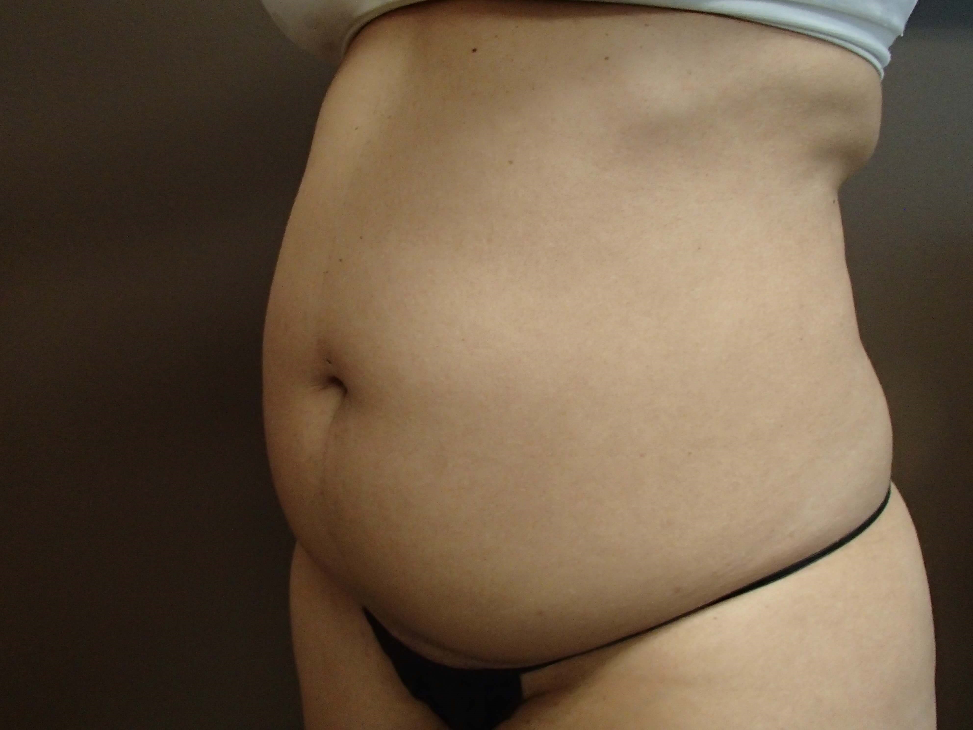 Liposuction Before