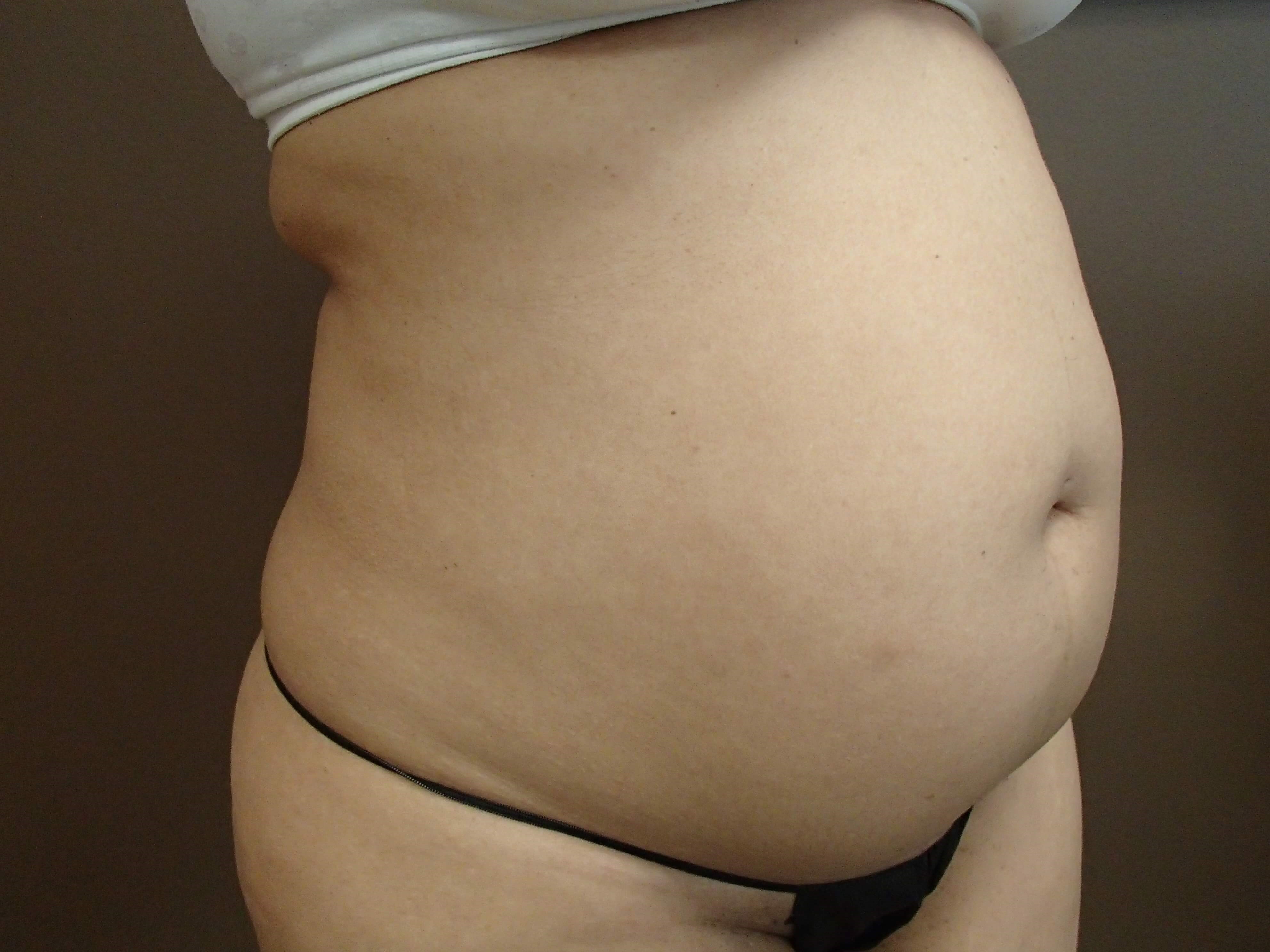 Liposuction Before